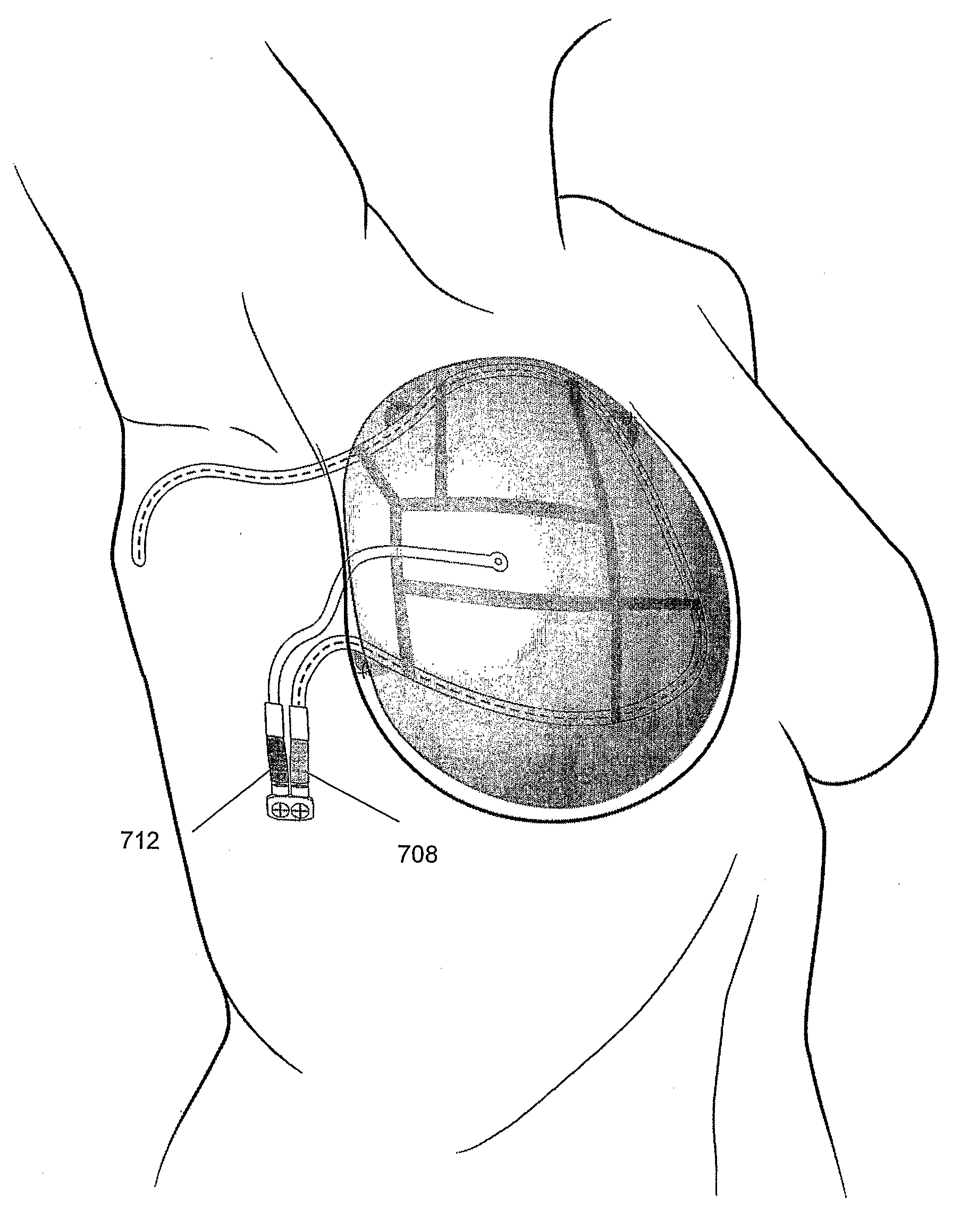 Methods and Devices for Breast Reconstruction
