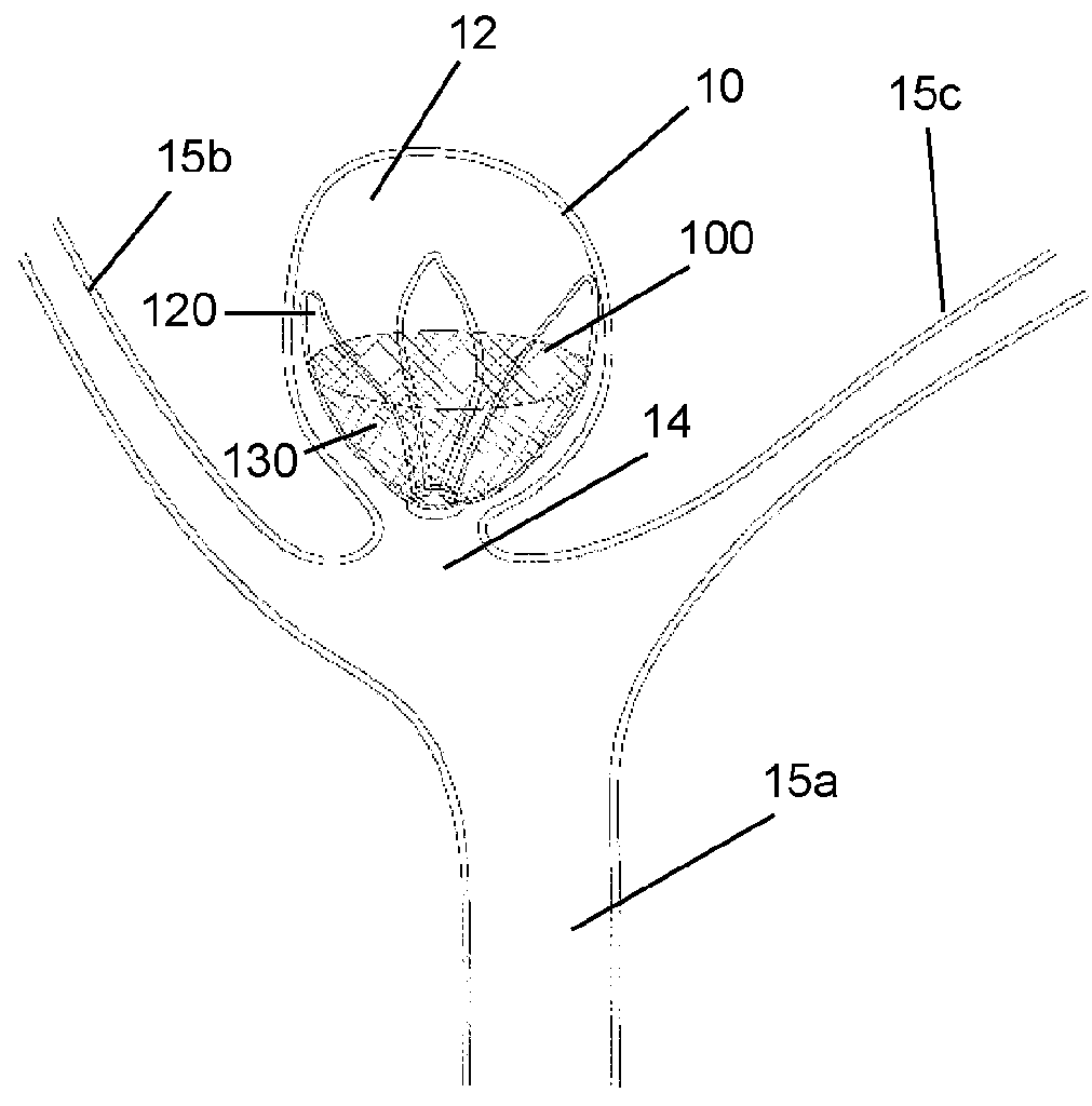 Aneurysm closure device