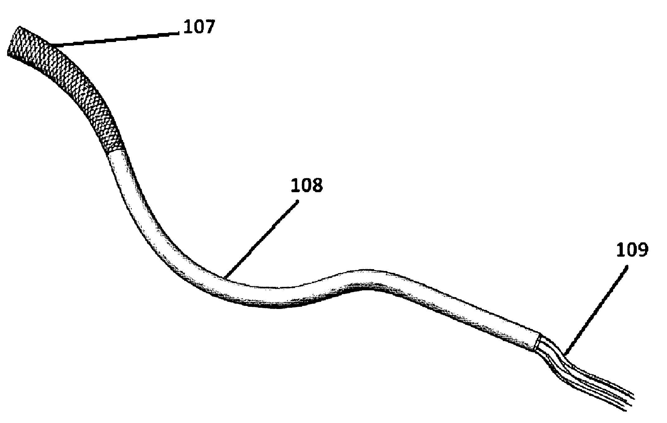 Retrievable urethra sparing prosthetic stent and kidney stone intervention system