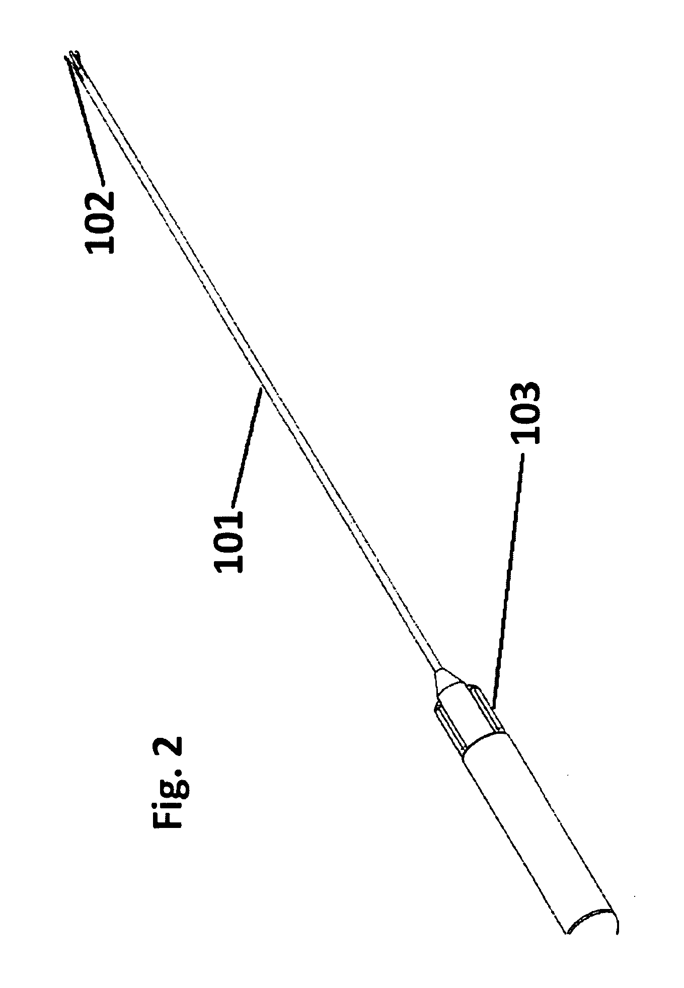 Retrievable urethra sparing prosthetic stent and kidney stone intervention system