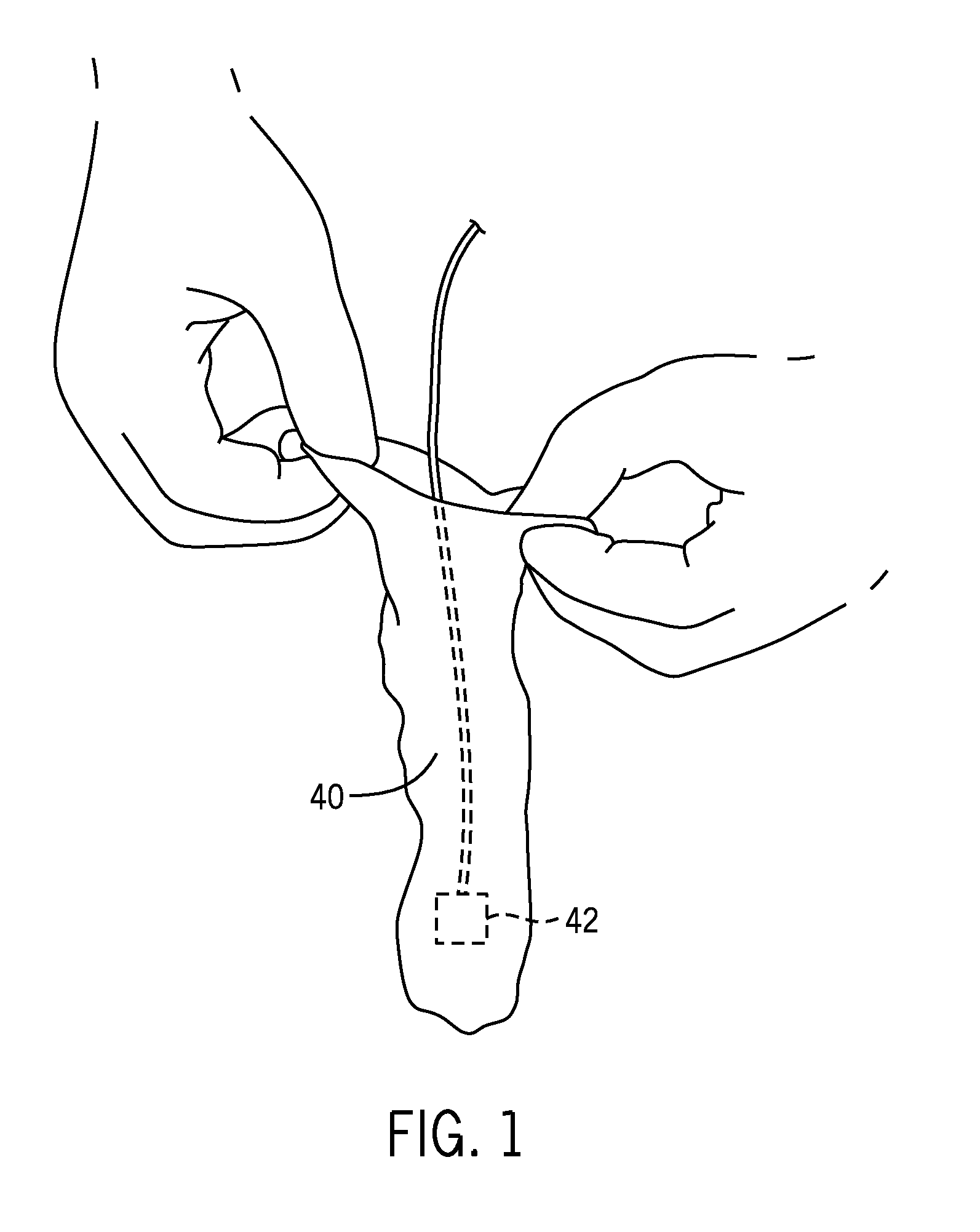 Colonoscopy systems and methods