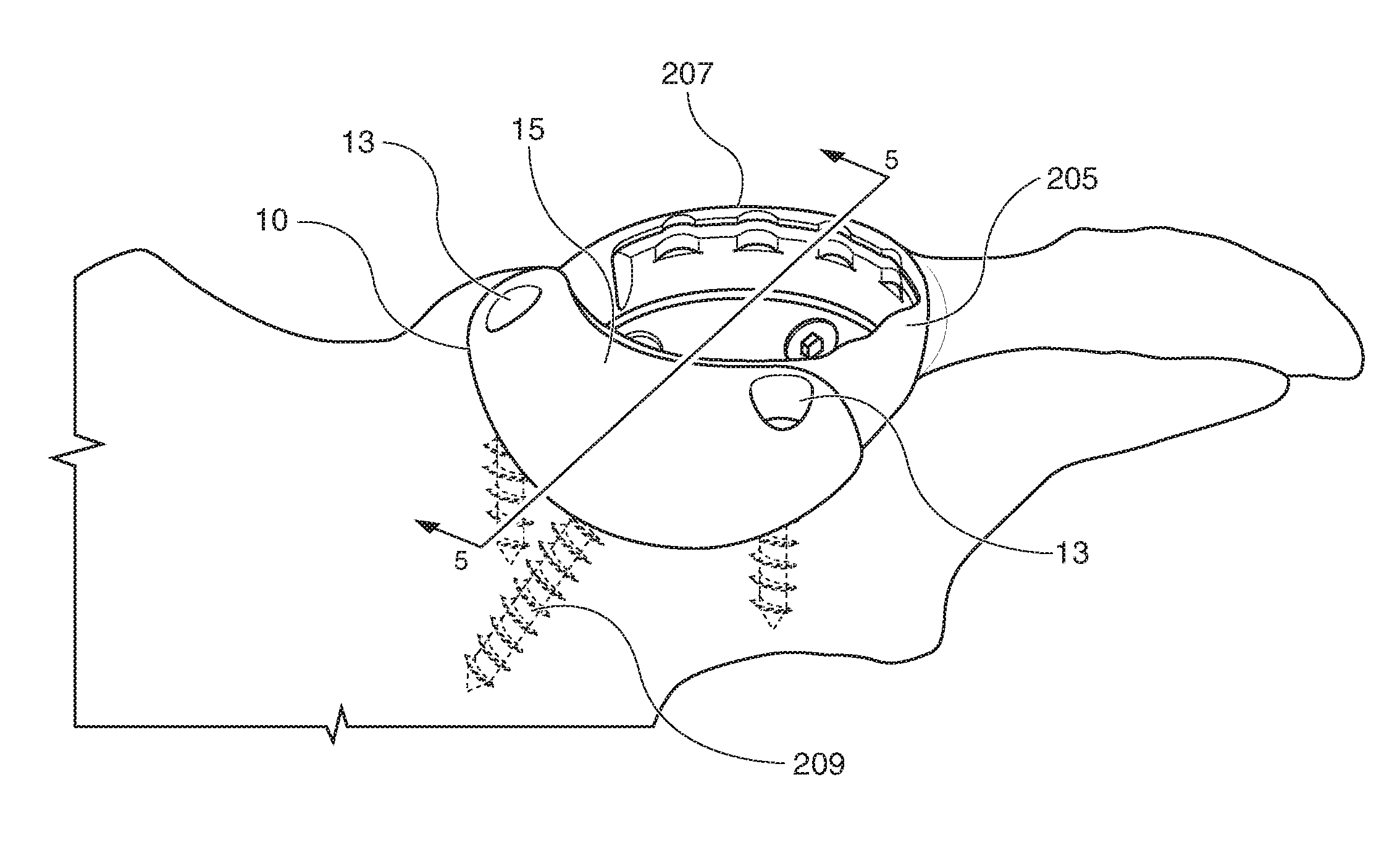 Patient-matched acetabular augment with alignment guide