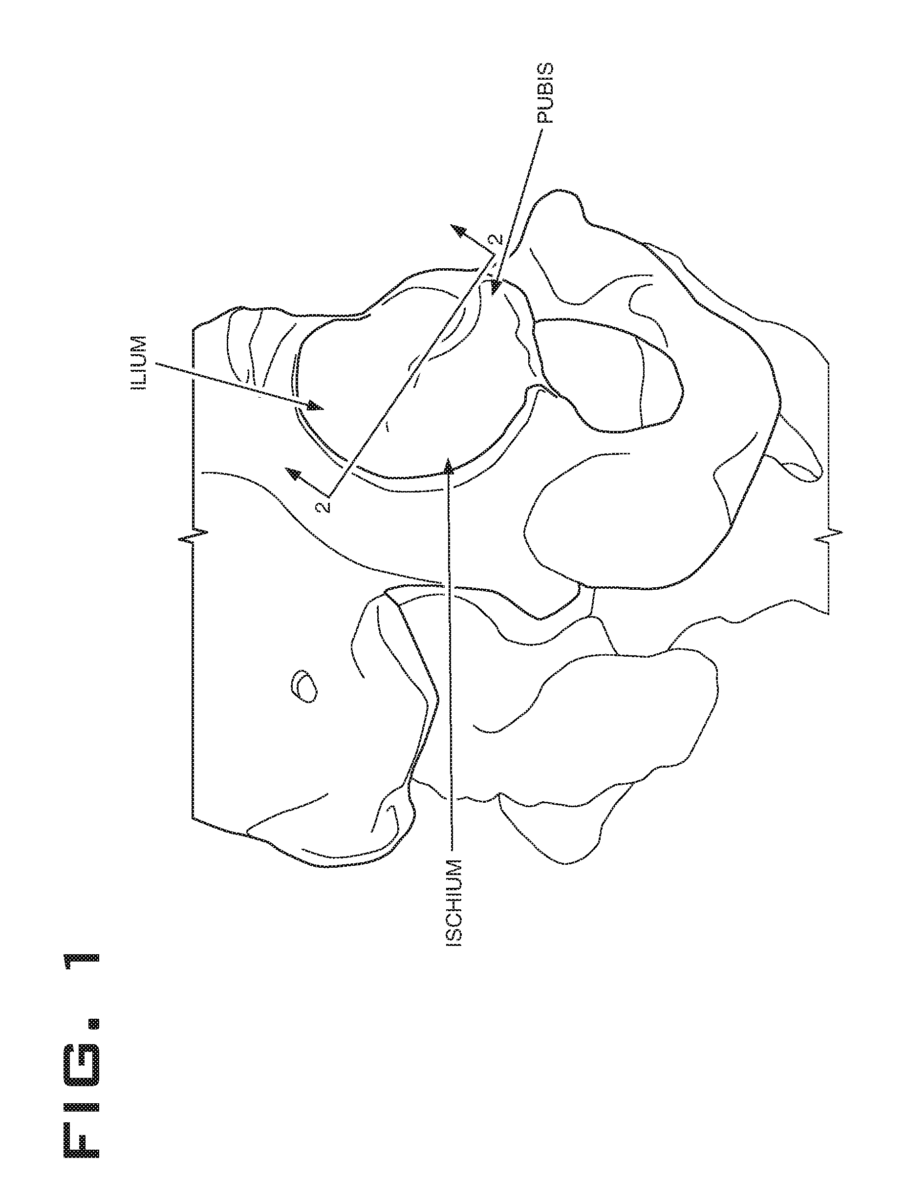 Patient-matched acetabular augment with alignment guide