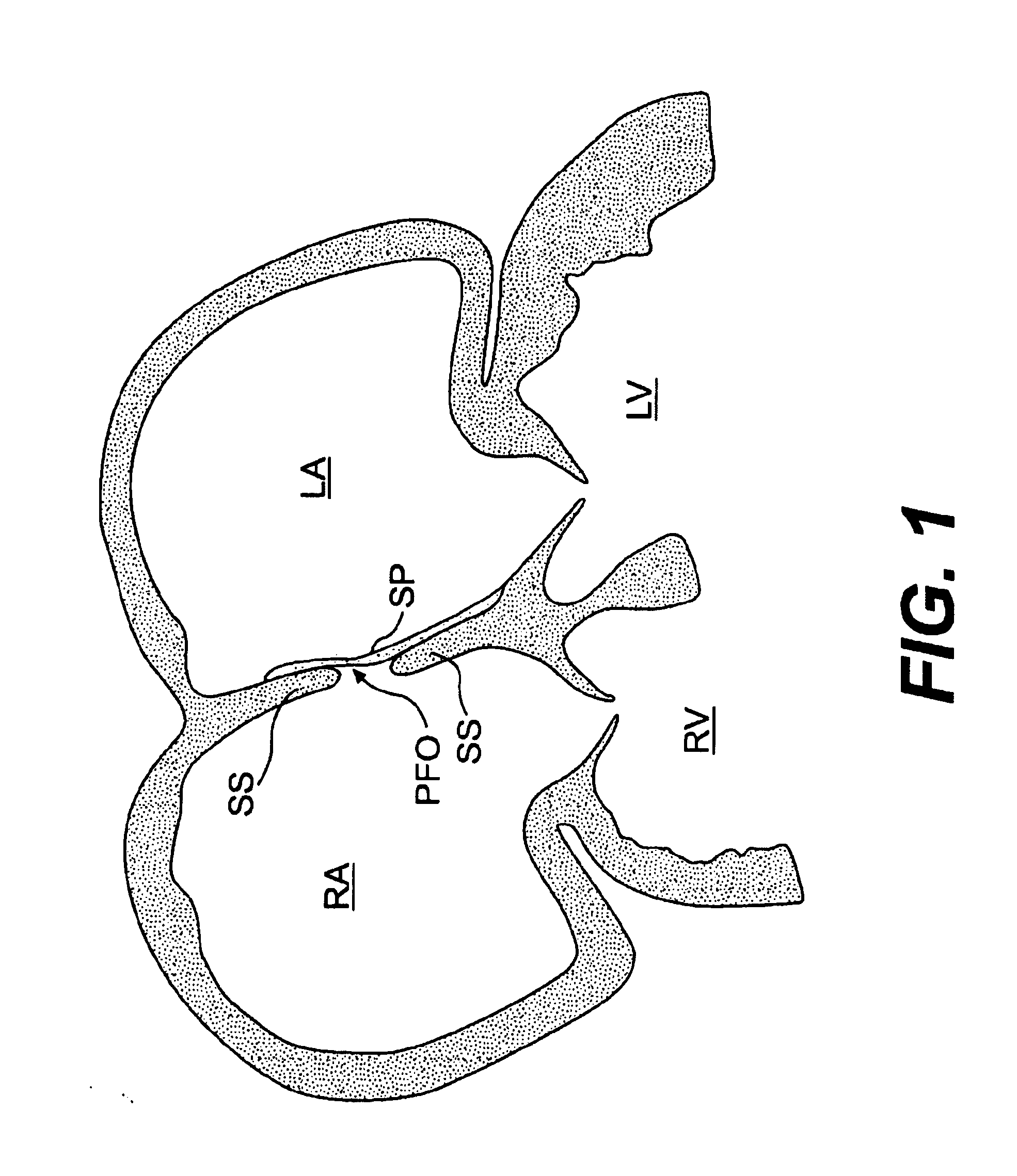 Closure devices, related delivery methods, and related methods of use