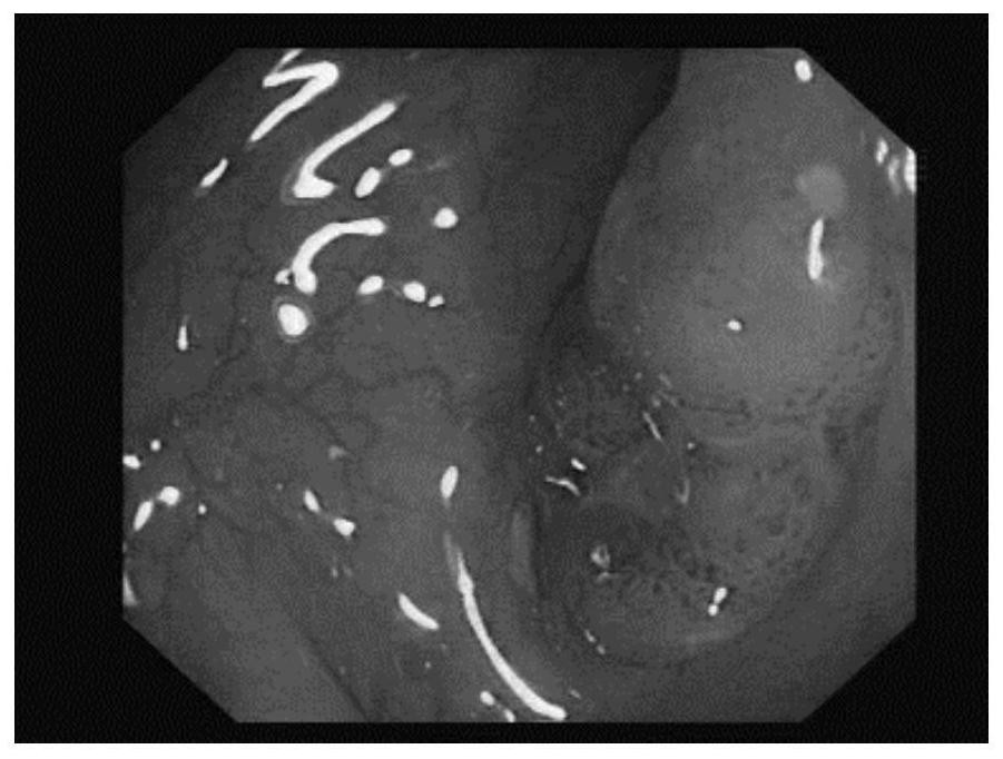 Detection and restoration system for mucous membrane image reflective area of endoscope