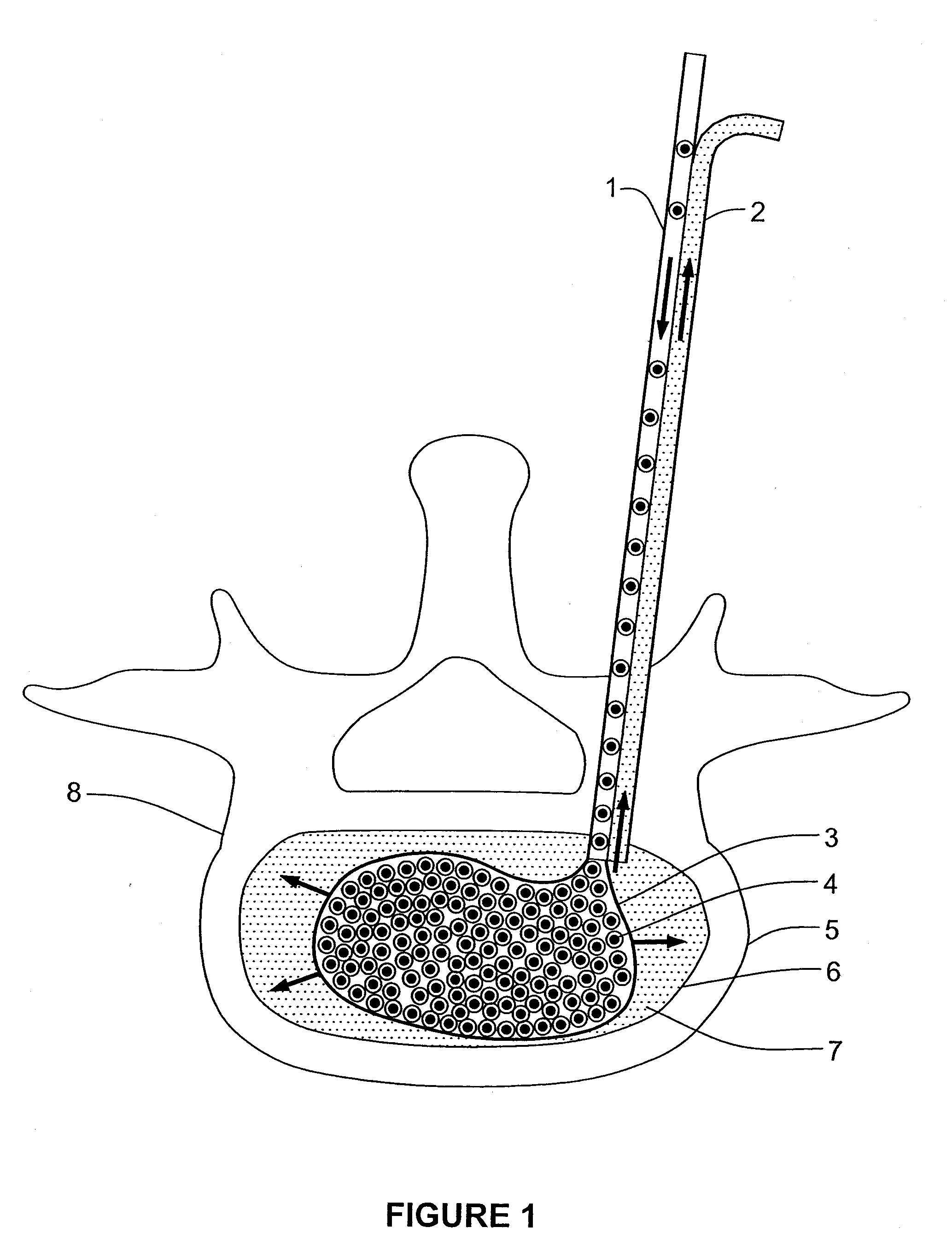 Method and device for reducing susceptibility to fractures in vertebral bodies