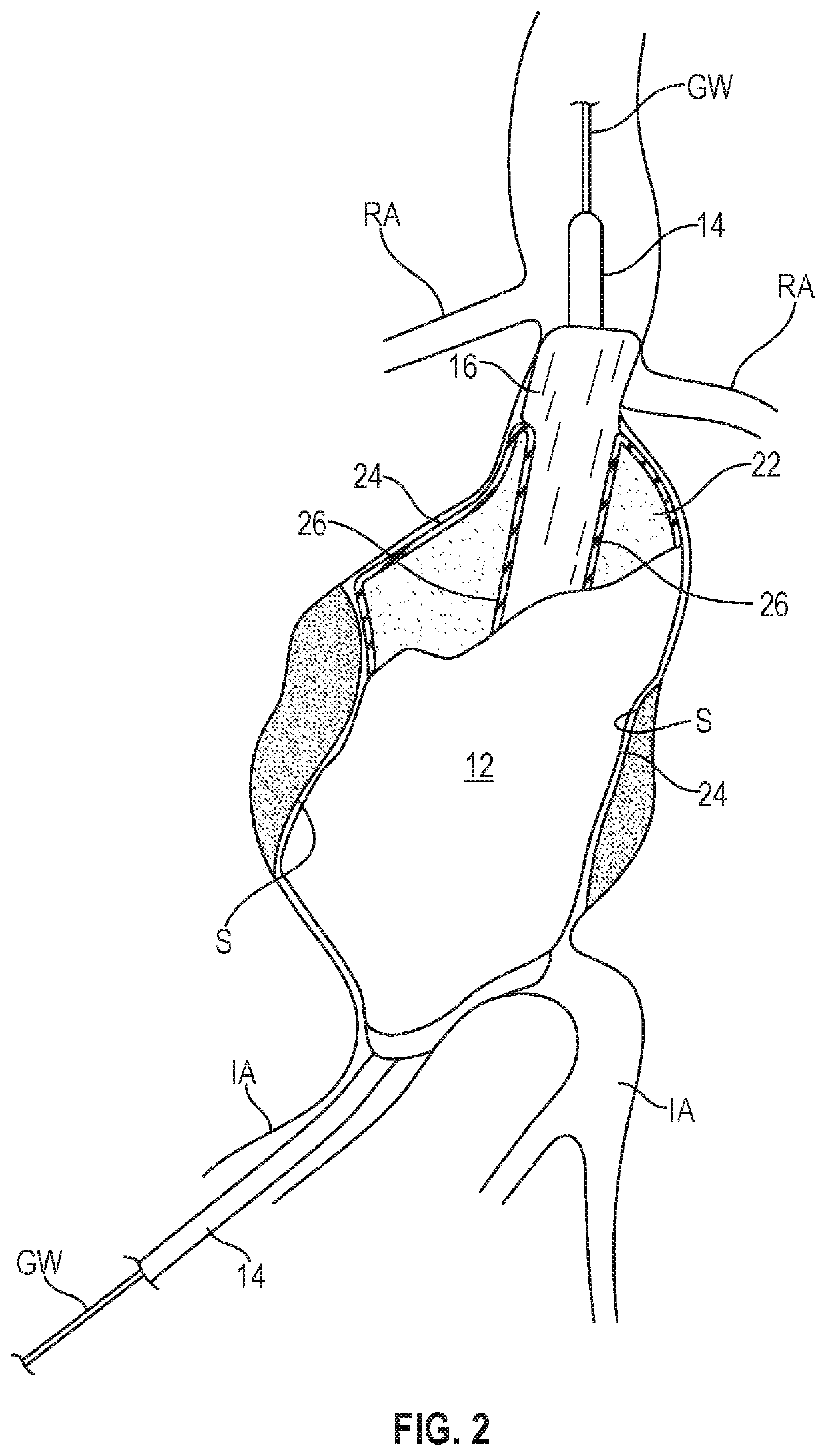 Modulation of inflammatory response following endovascular treatment