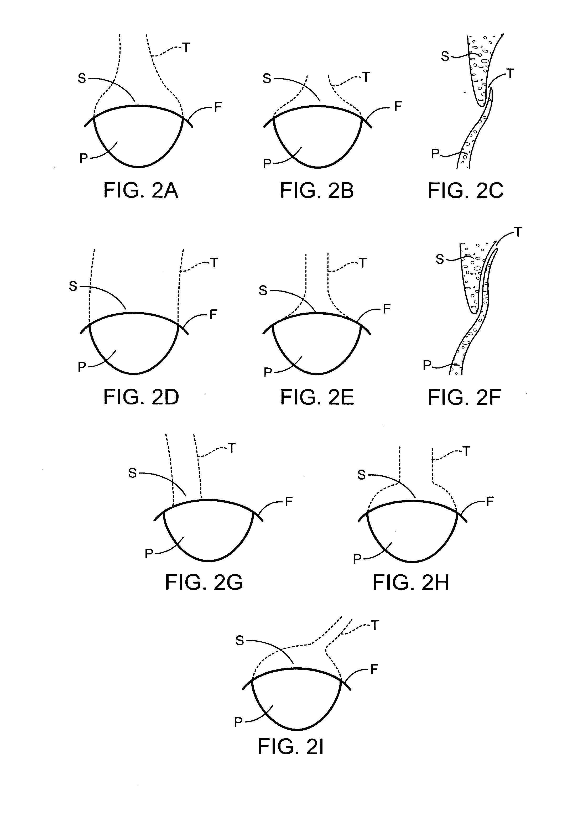 Methods and apparatus to achieve a closure of a layered tissue defect