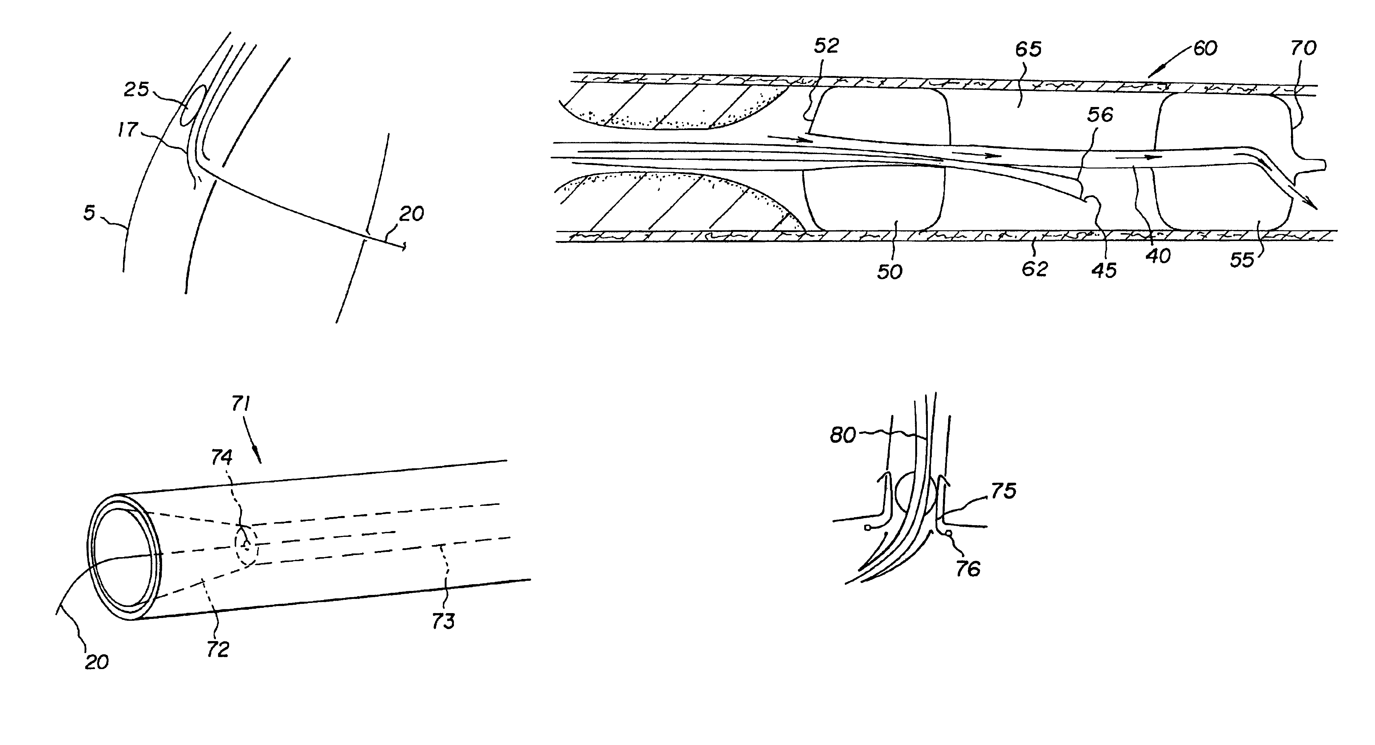 Method and apparatus for performing an anastamosis