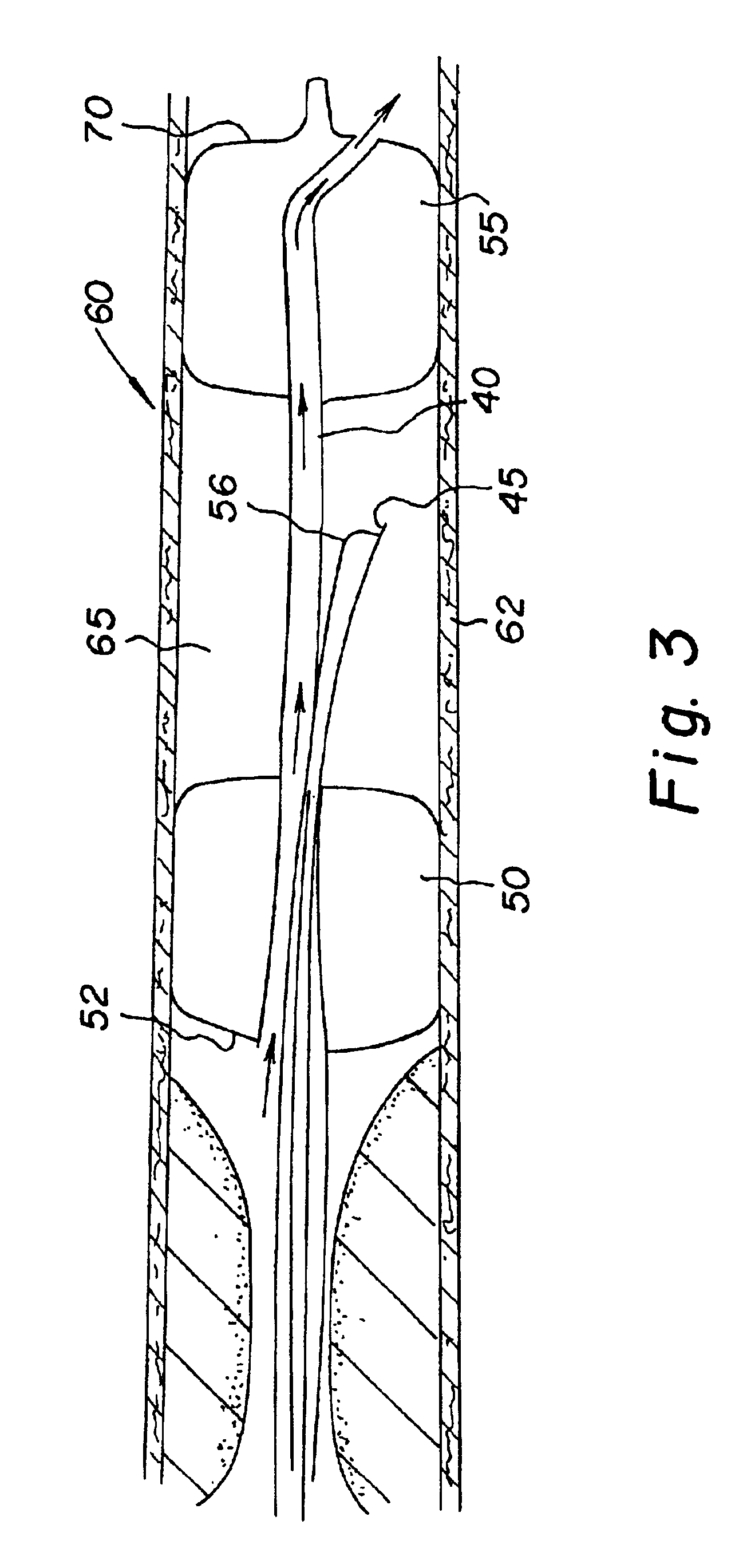 Method and apparatus for performing an anastamosis