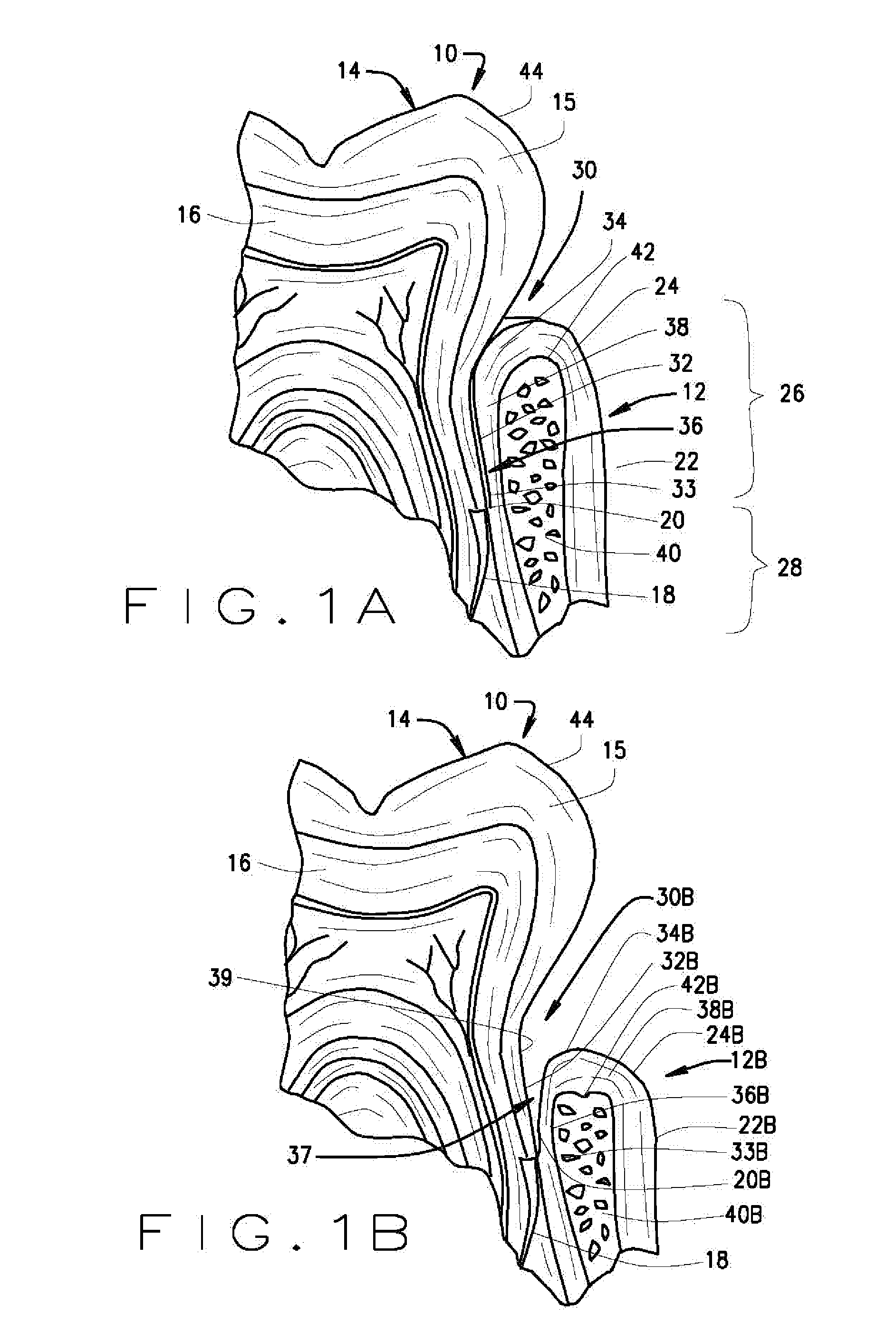 Article and method of initiating bone regrowth and restoration of gum recession with localized subgingival delivery of medications