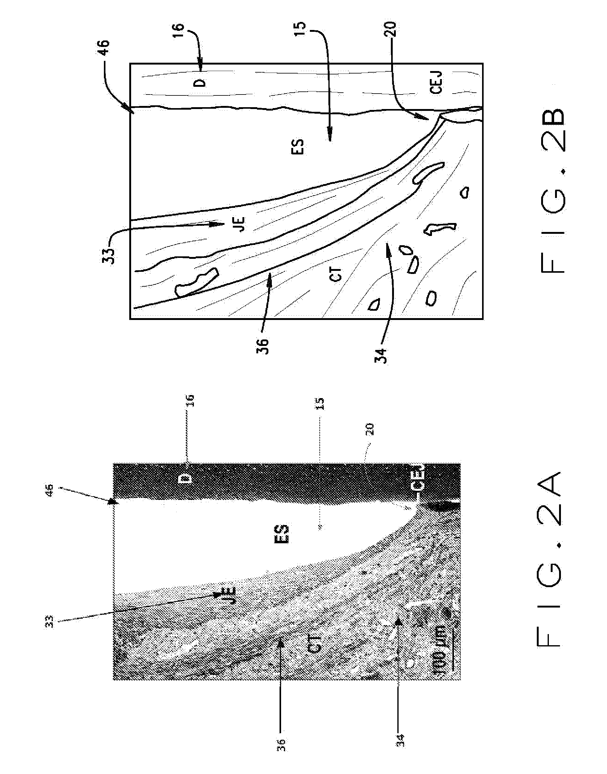 Article and method of initiating bone regrowth and restoration of gum recession with localized subgingival delivery of medications