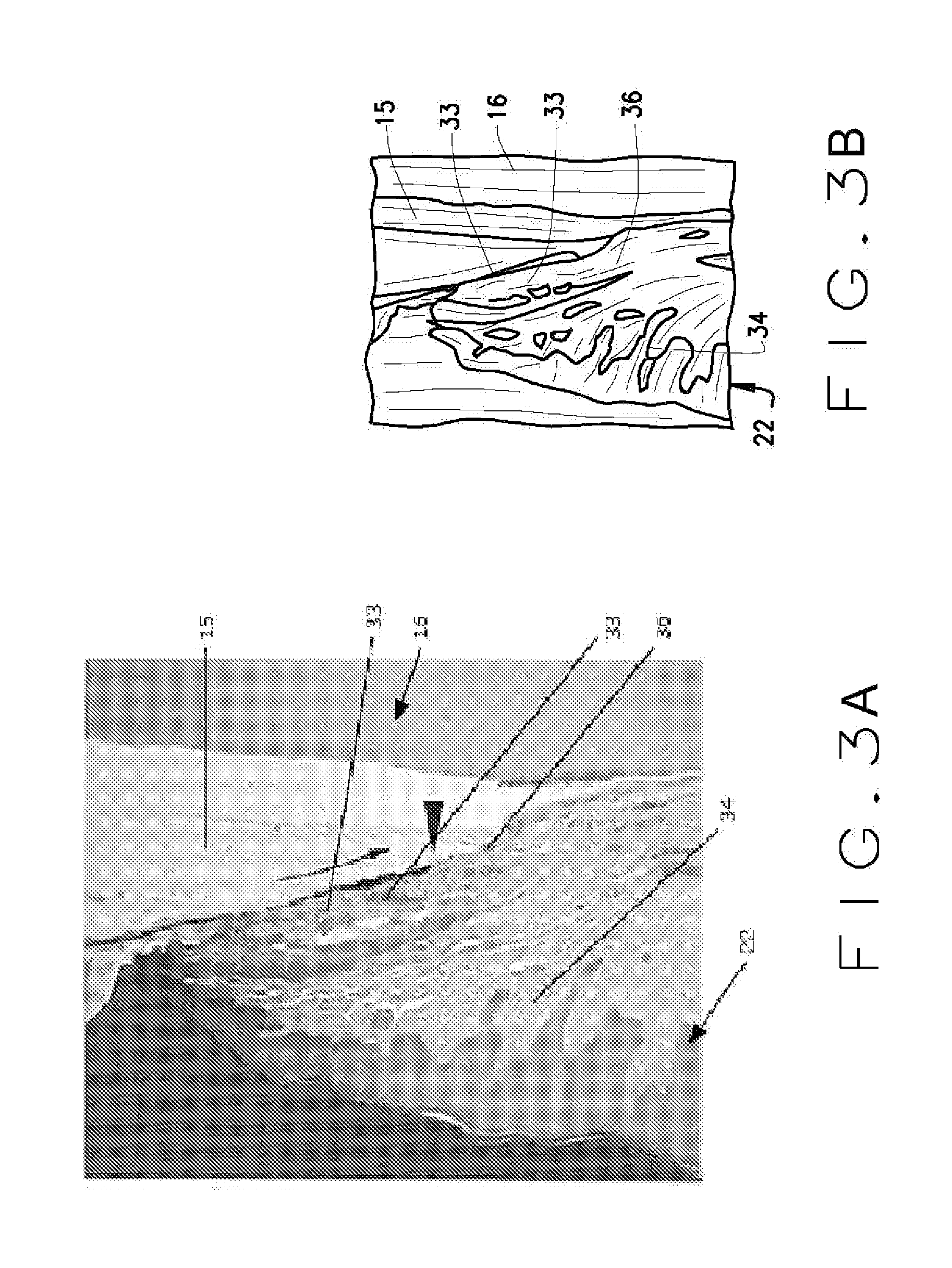 Article and method of initiating bone regrowth and restoration of gum recession with localized subgingival delivery of medications