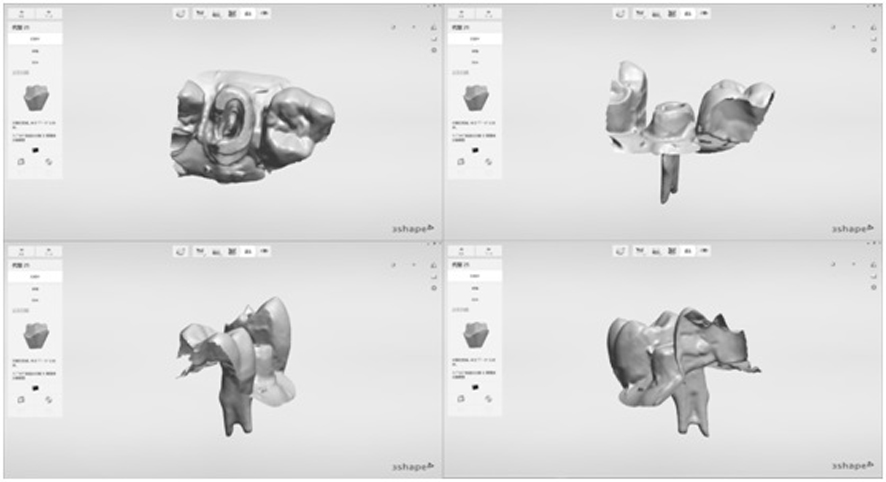 A Novel Digital Post-core Impression Acquisition and Model Establishment Method Without Plasterization