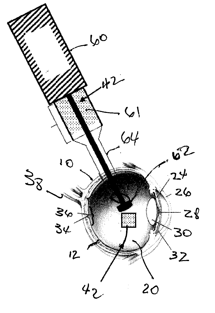 Methods and devices for treating a retinal detachment