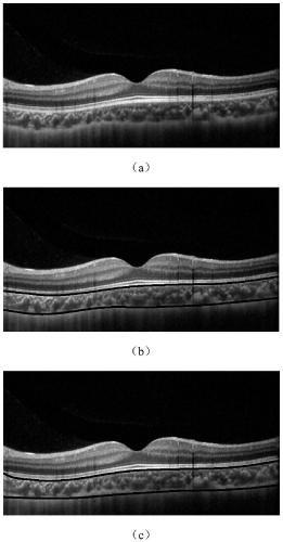 Method for automatically estimating choroid thickness