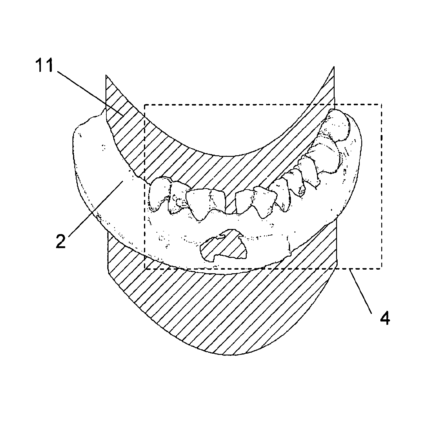 Method for creating a personalized digital planning file for simulation of dental implant placement