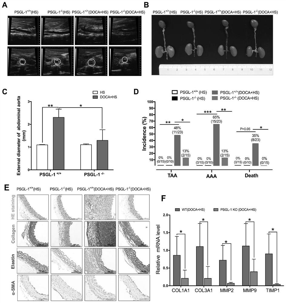 Application of p-selectin glycoprotein ligand-1 as a target in the preparation of drugs for preventing and/or treating aneurysms