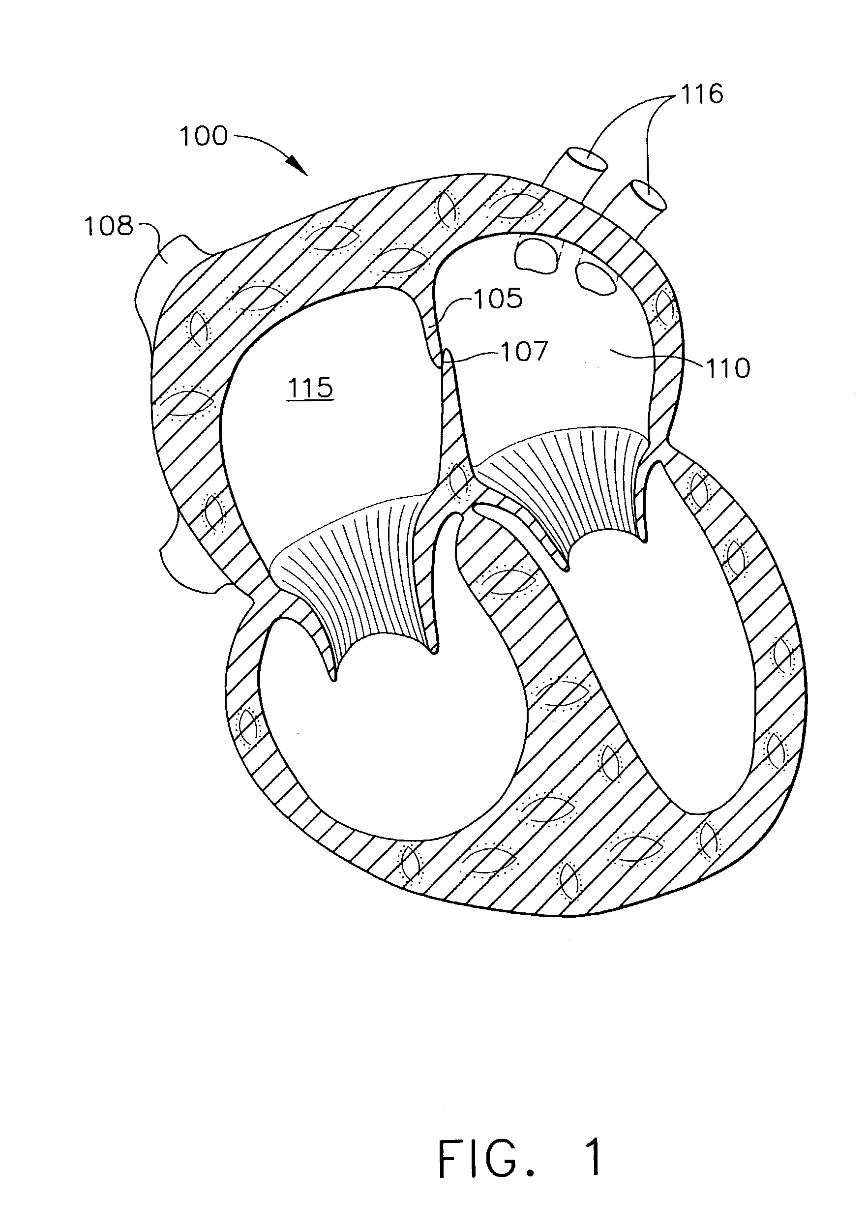 Method and device for transseptal facilitation based on injury patterns