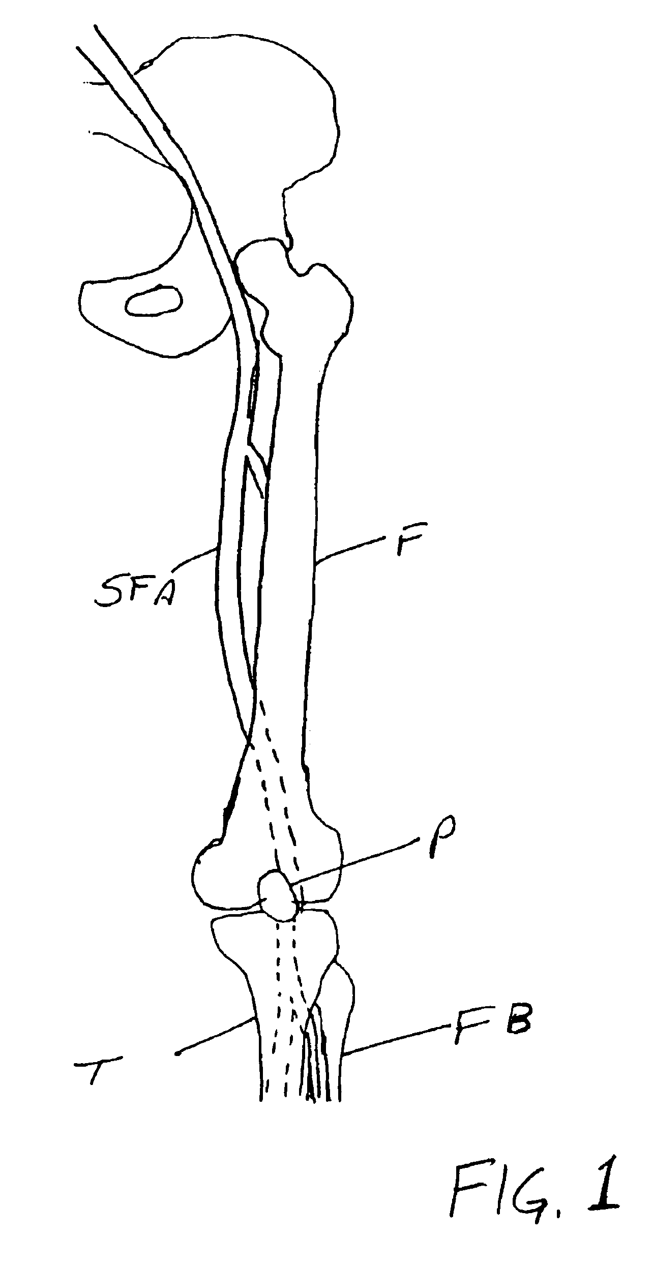 Fracture-resistant helical stent incorporating bistable cells and methods of use
