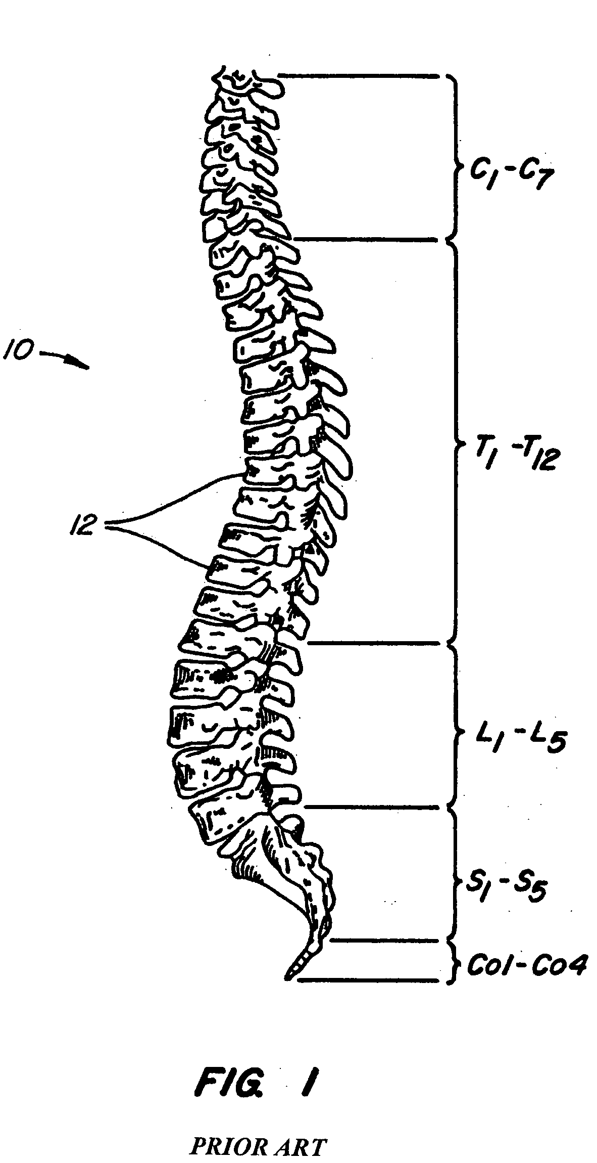 Adjacent level facet arthroplasty devices, spine stabilization systems, and methods