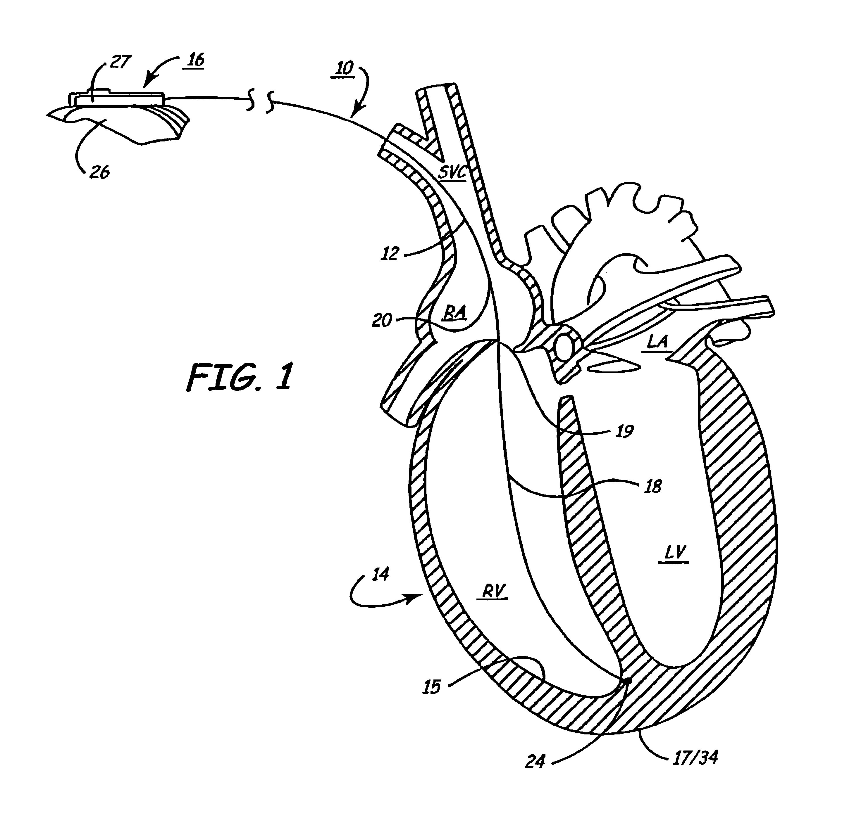 Arrangement for implanting an endocardial cardiac lead