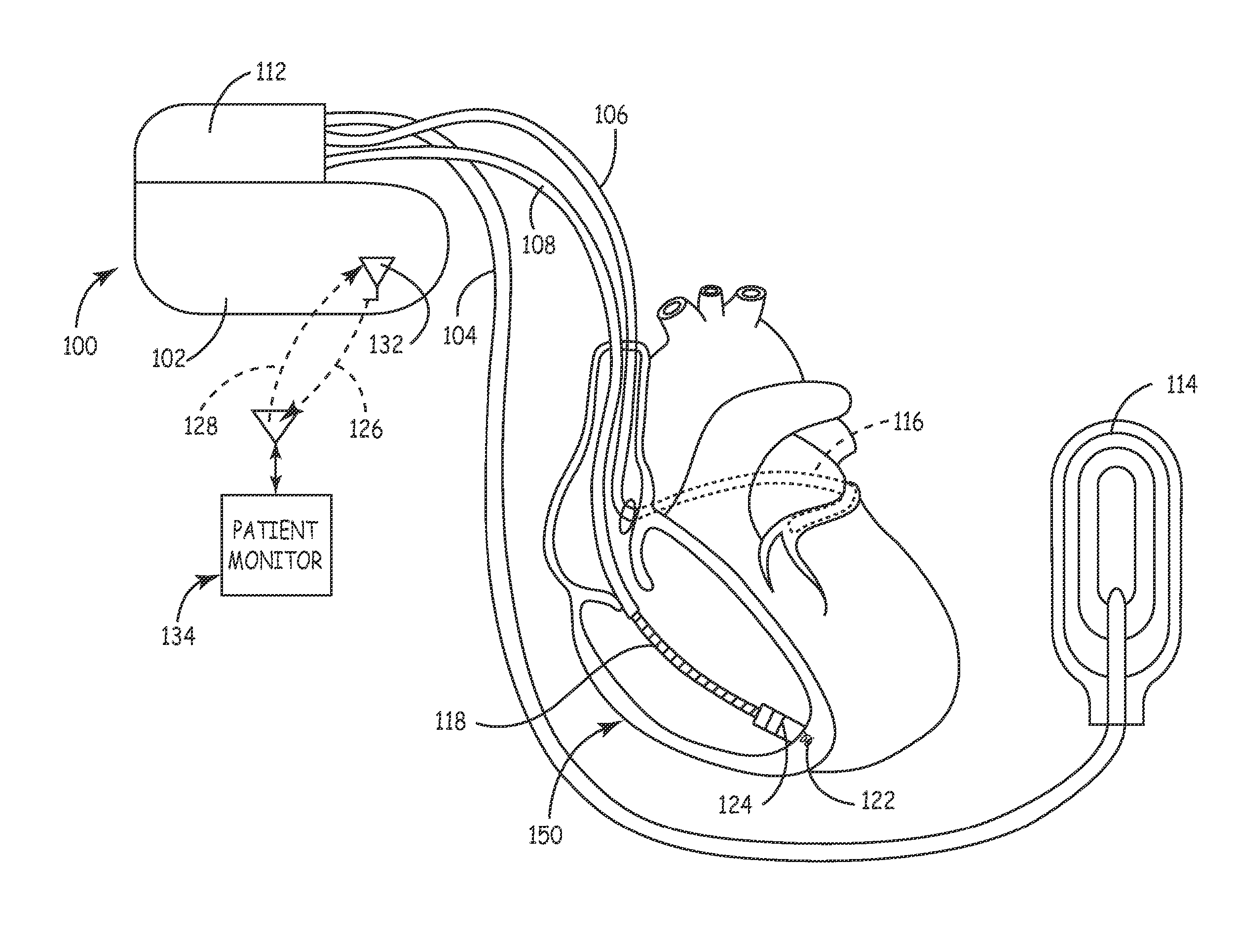 System and Method for Real-Time Remote Monitoring of Implantable Medical Devices