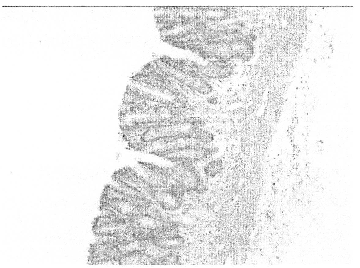 Application of resina draconis to preparing compound enema for treating ulcerative colitis