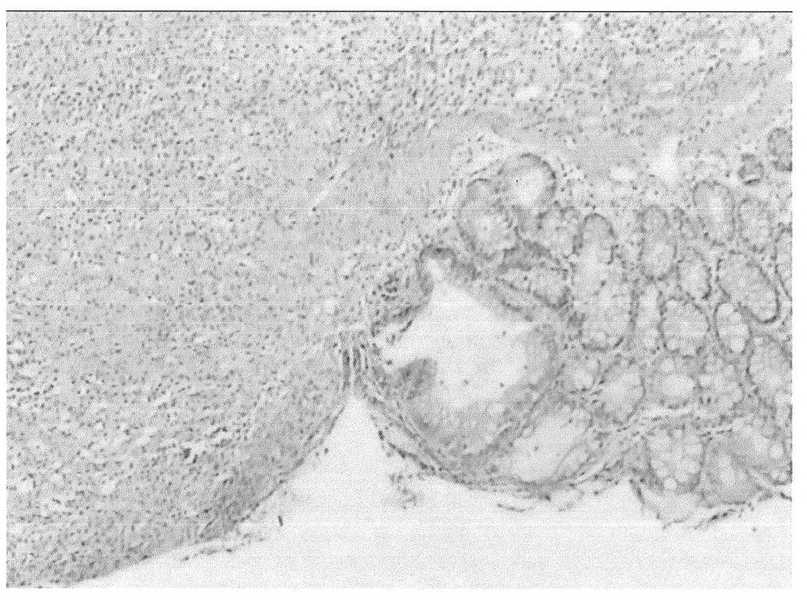 Application of resina draconis to preparing compound enema for treating ulcerative colitis