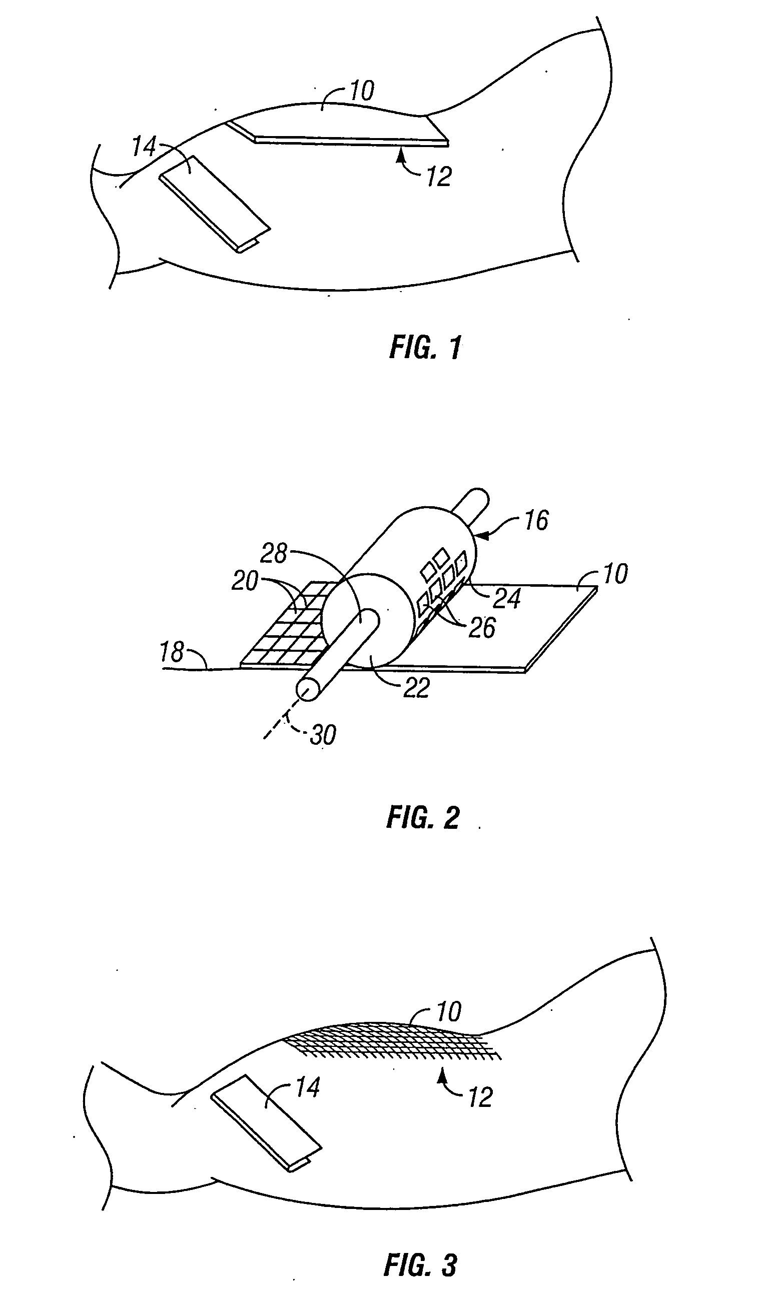 Tissue harvesting device and method