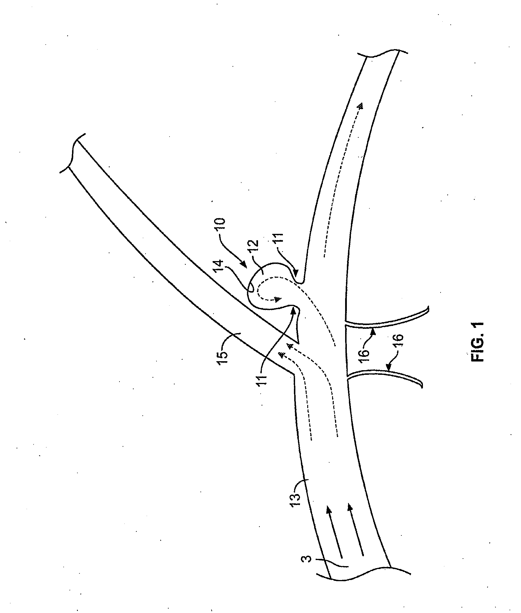 Procedures for vascular occlusion