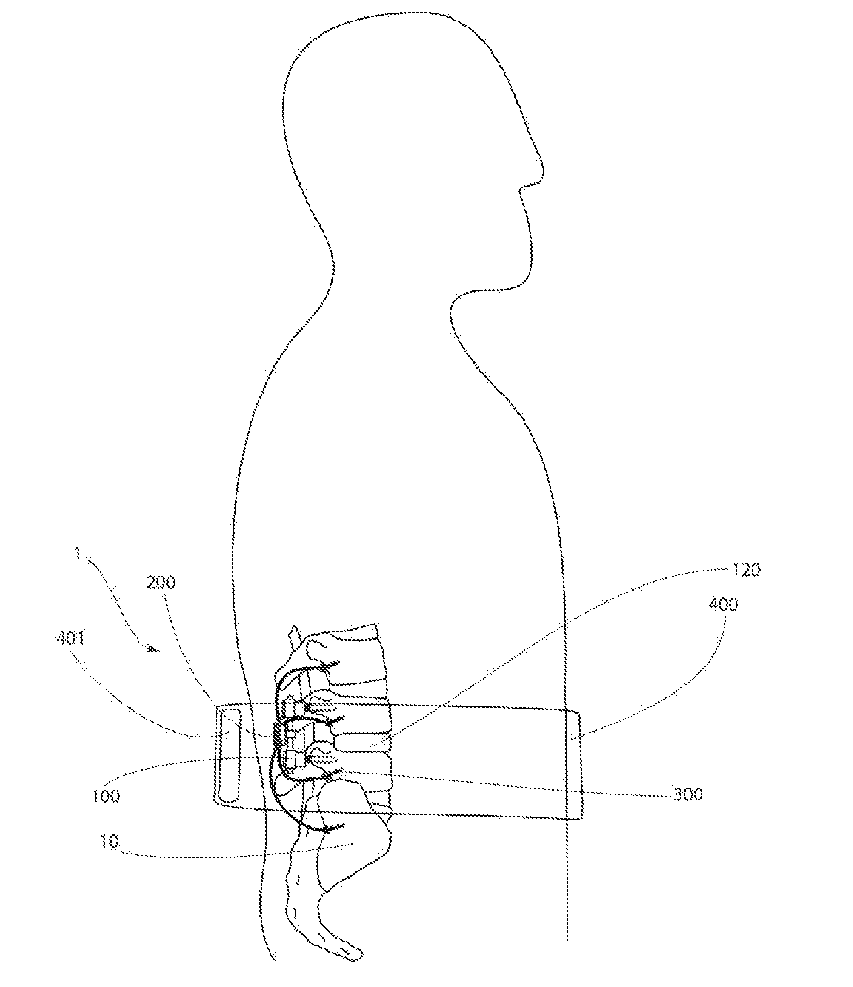 Method and Apparatus for an Implantable Inertial-Based Sensing System for Real-Time, In Vivo Detection of Spinal Pseudarthrosis and Adjacent Segment Motion