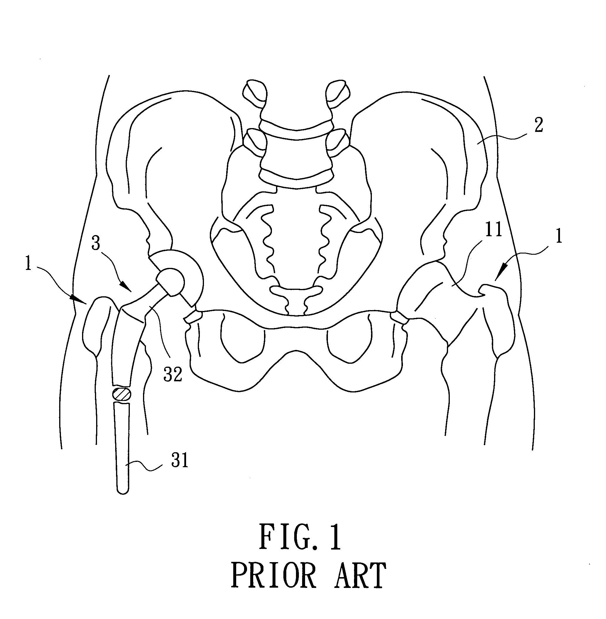 Artificial bone and a method for making the same