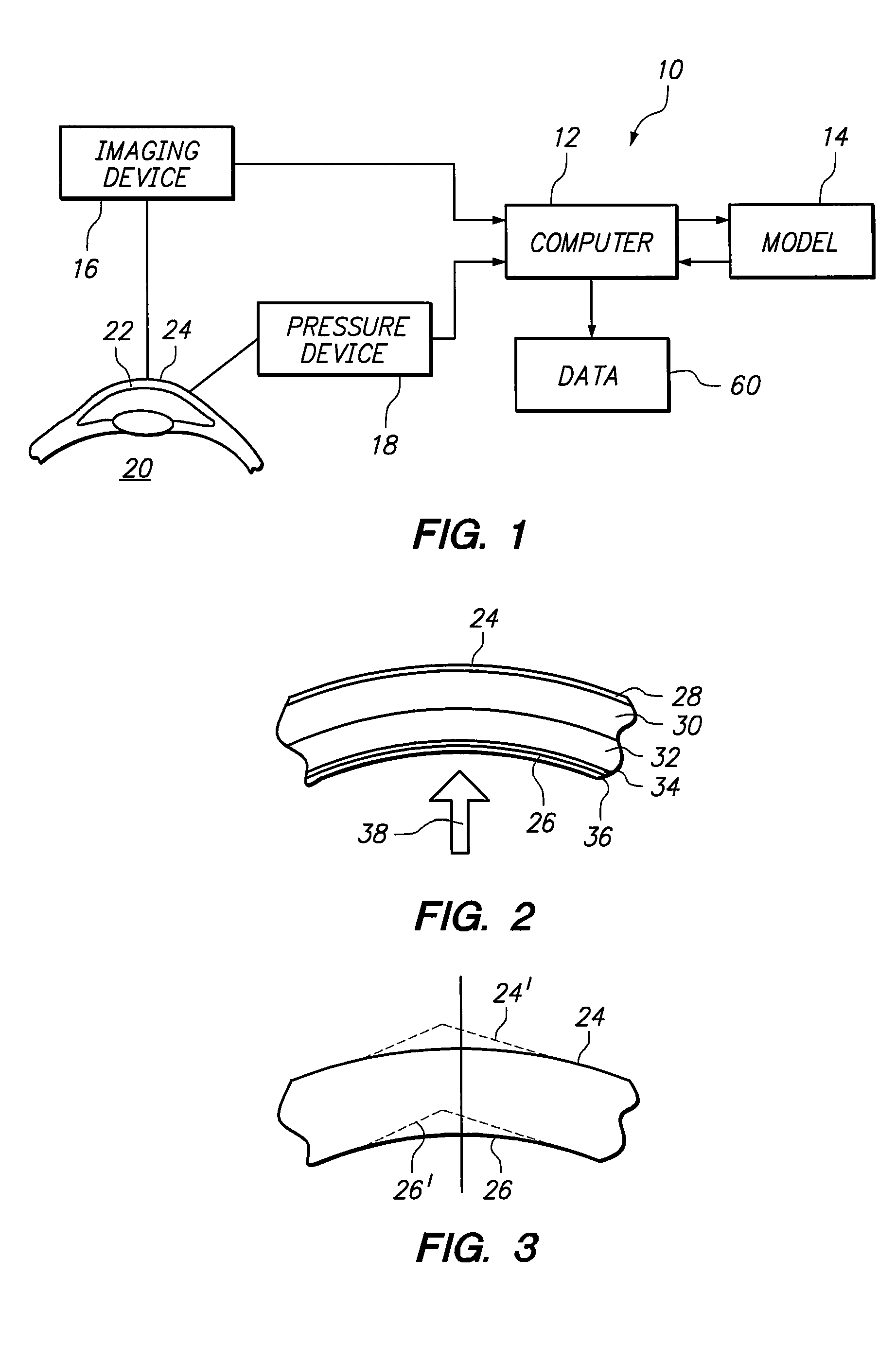 Finite element model of a keratoconic cornea