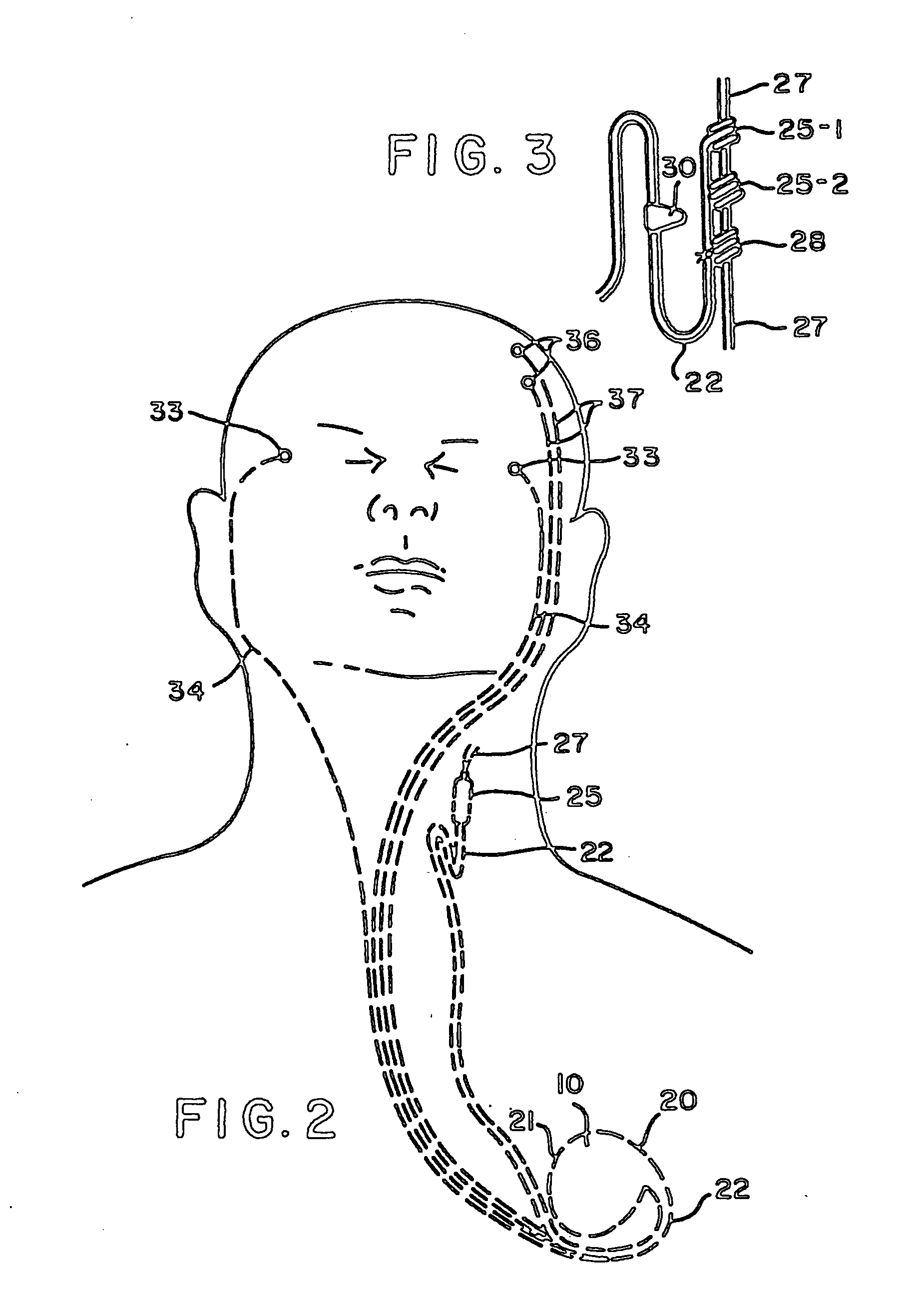 Vagus nerve stimulation for treatment of depression with therapeutically beneficial parameter settings