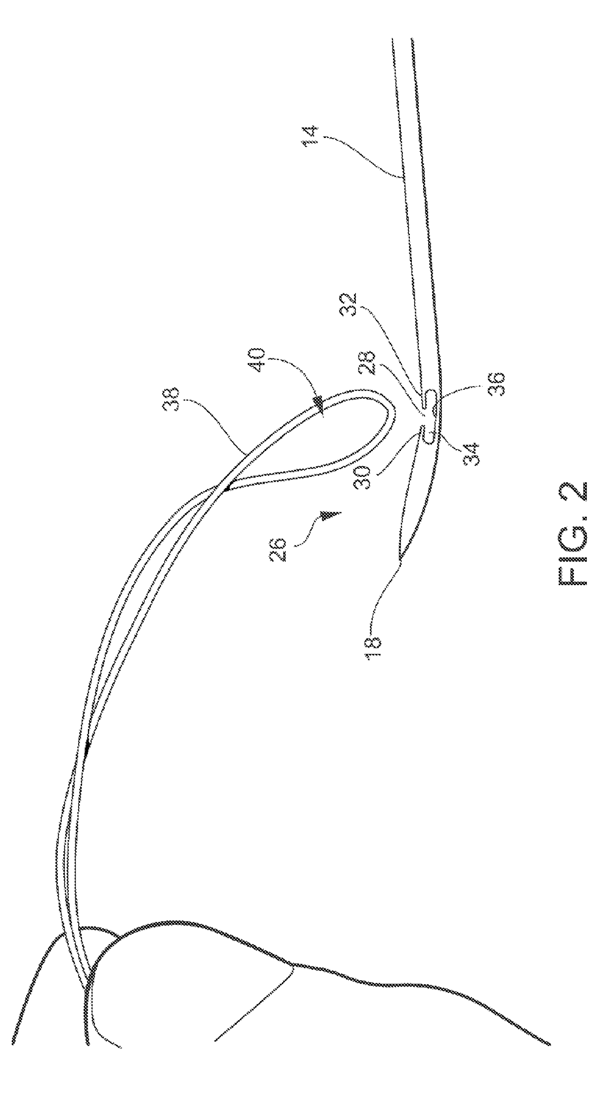 Device And Methods For Use In Robotic Assisted Surgery For Treatment Of Obstructive Sleep Apnea