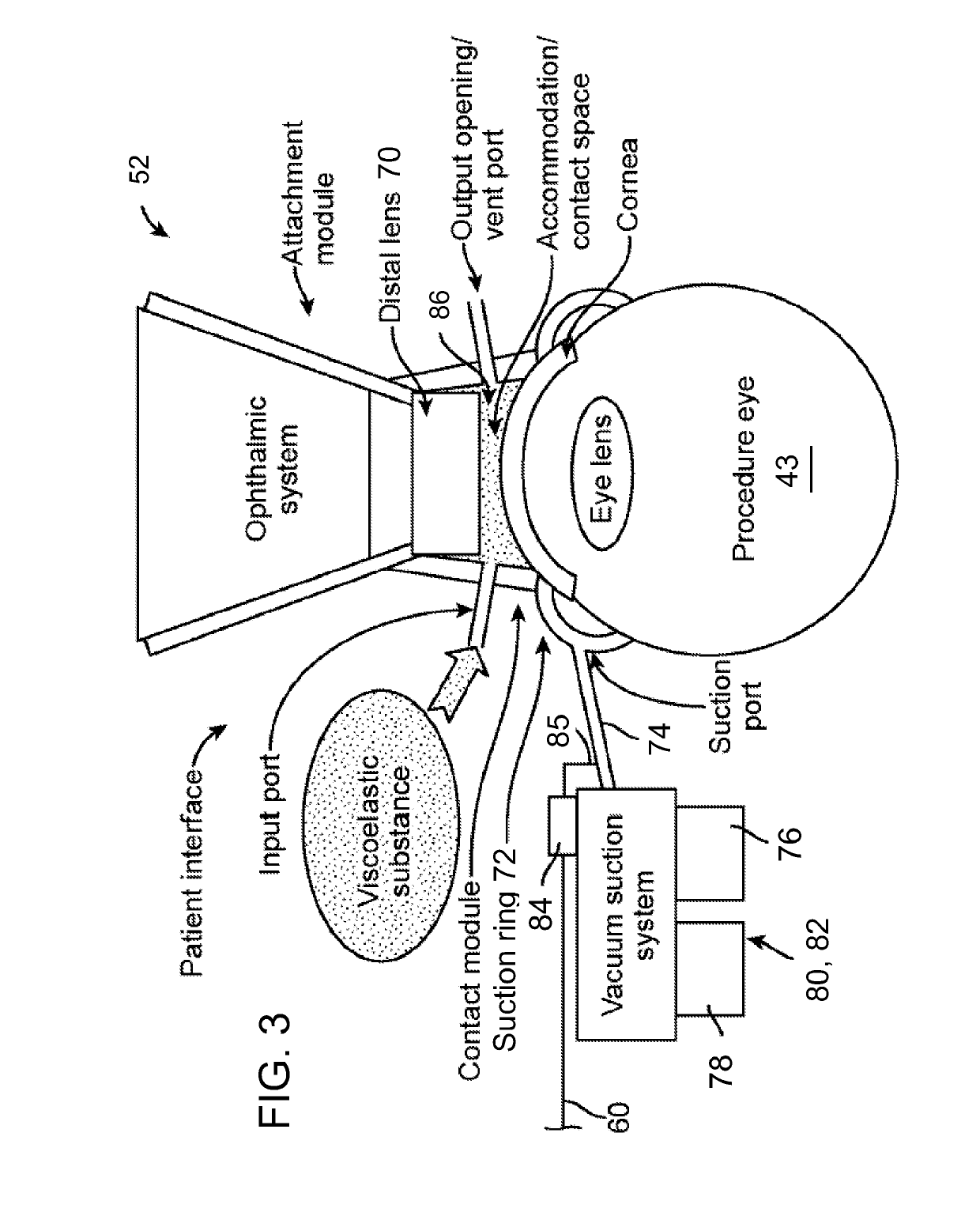 Vacuum loss detection during laser eye surgery