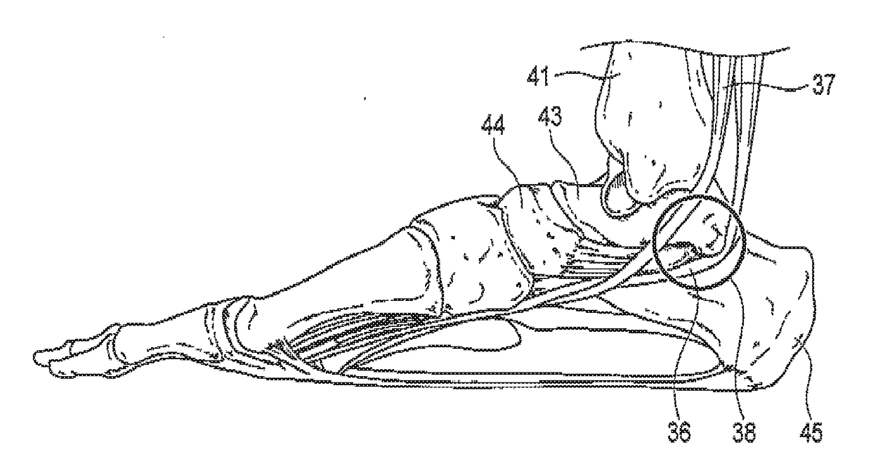 Arthroscopic surgery method for ankle impingement