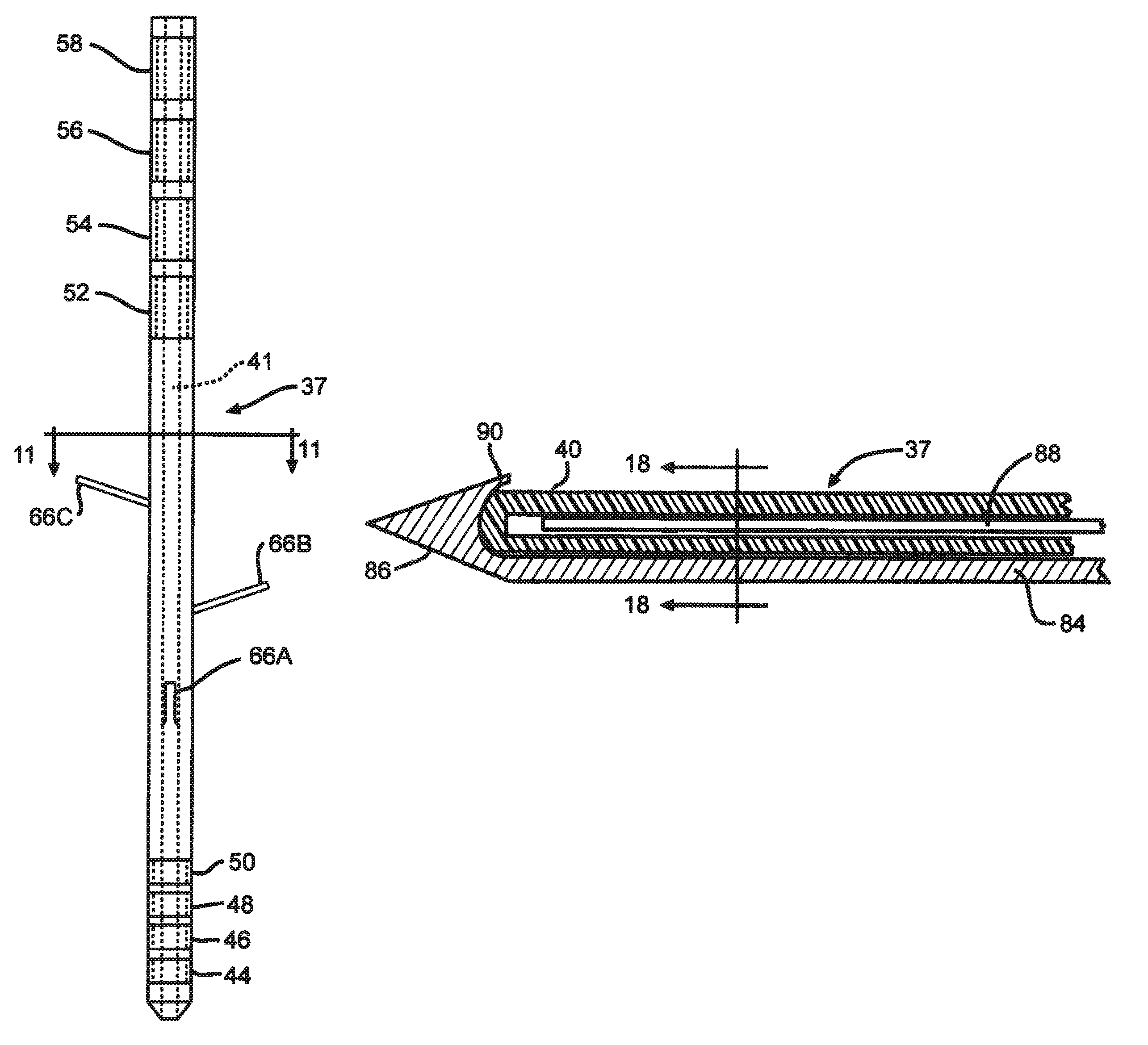 Minimally invasive methods for implanting a sacral stimulation lead