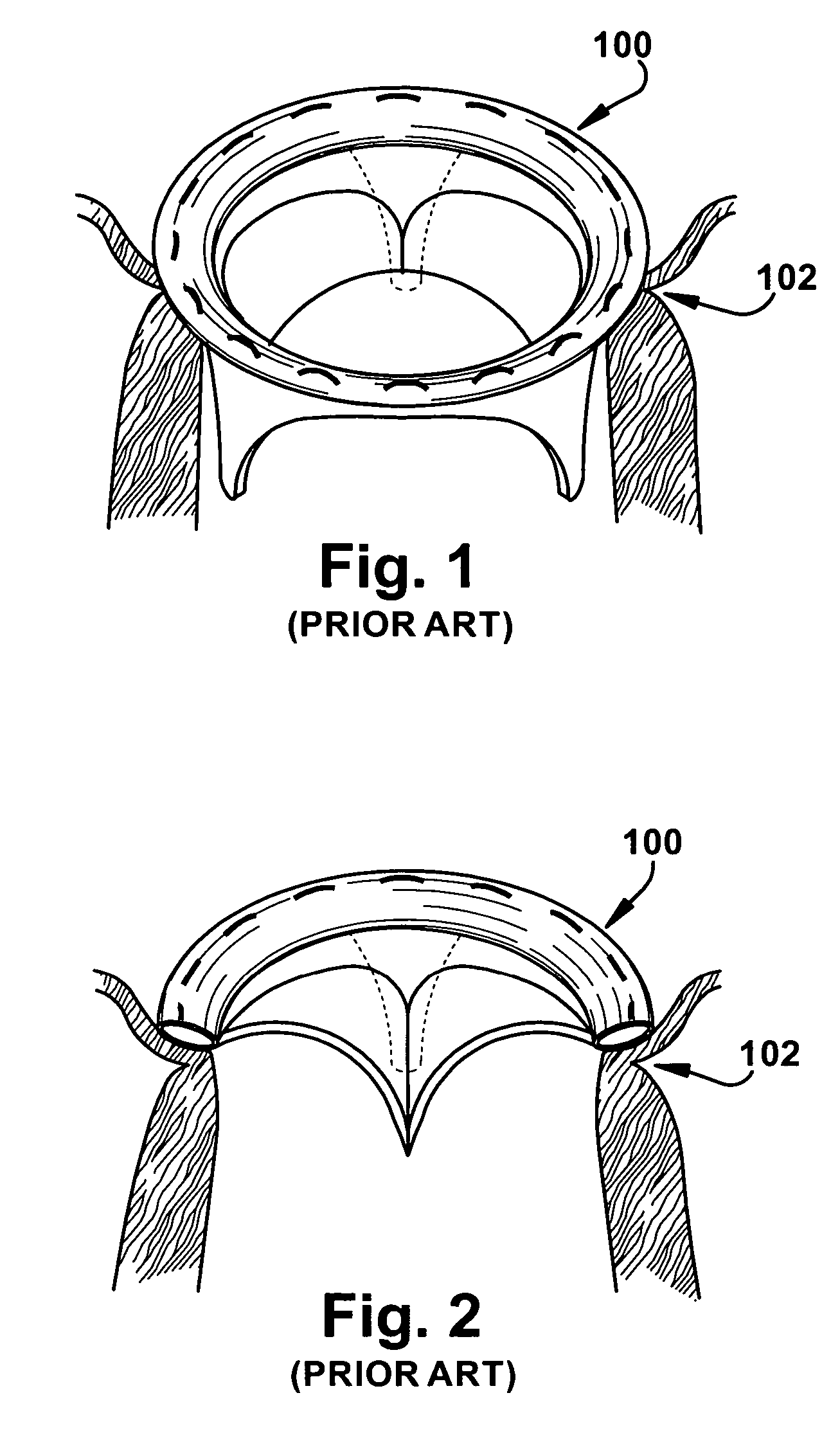 Apparatus and method for replacing a cardiac valve