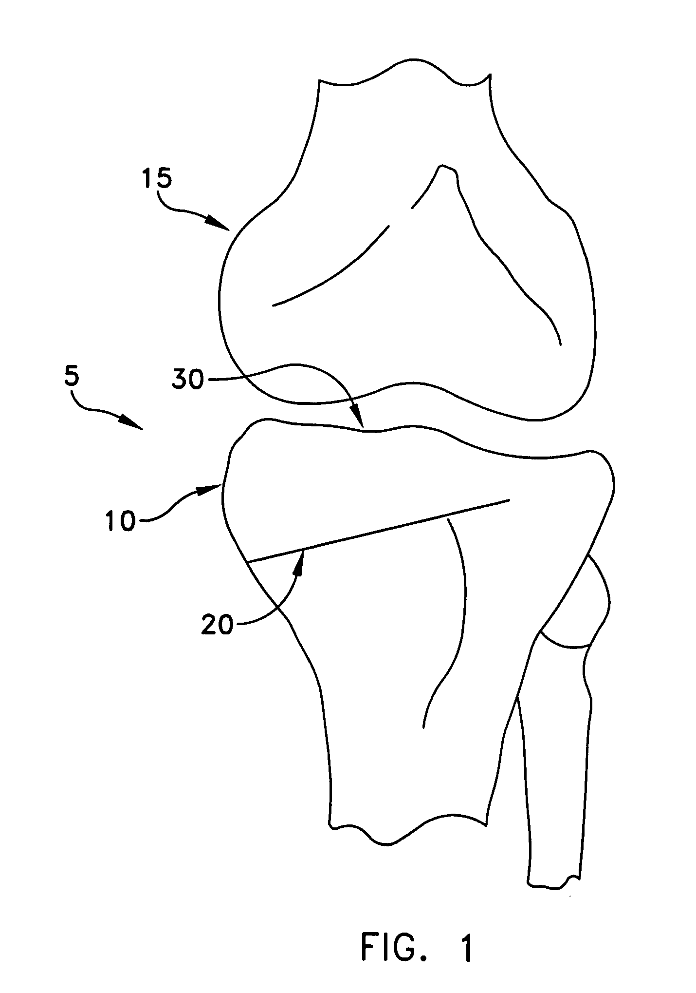 Method and apparatus for performing a high tibial, dome osteotomy