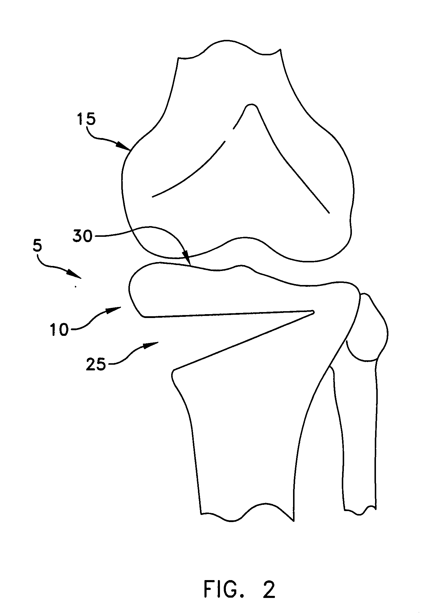 Method and apparatus for performing a high tibial, dome osteotomy