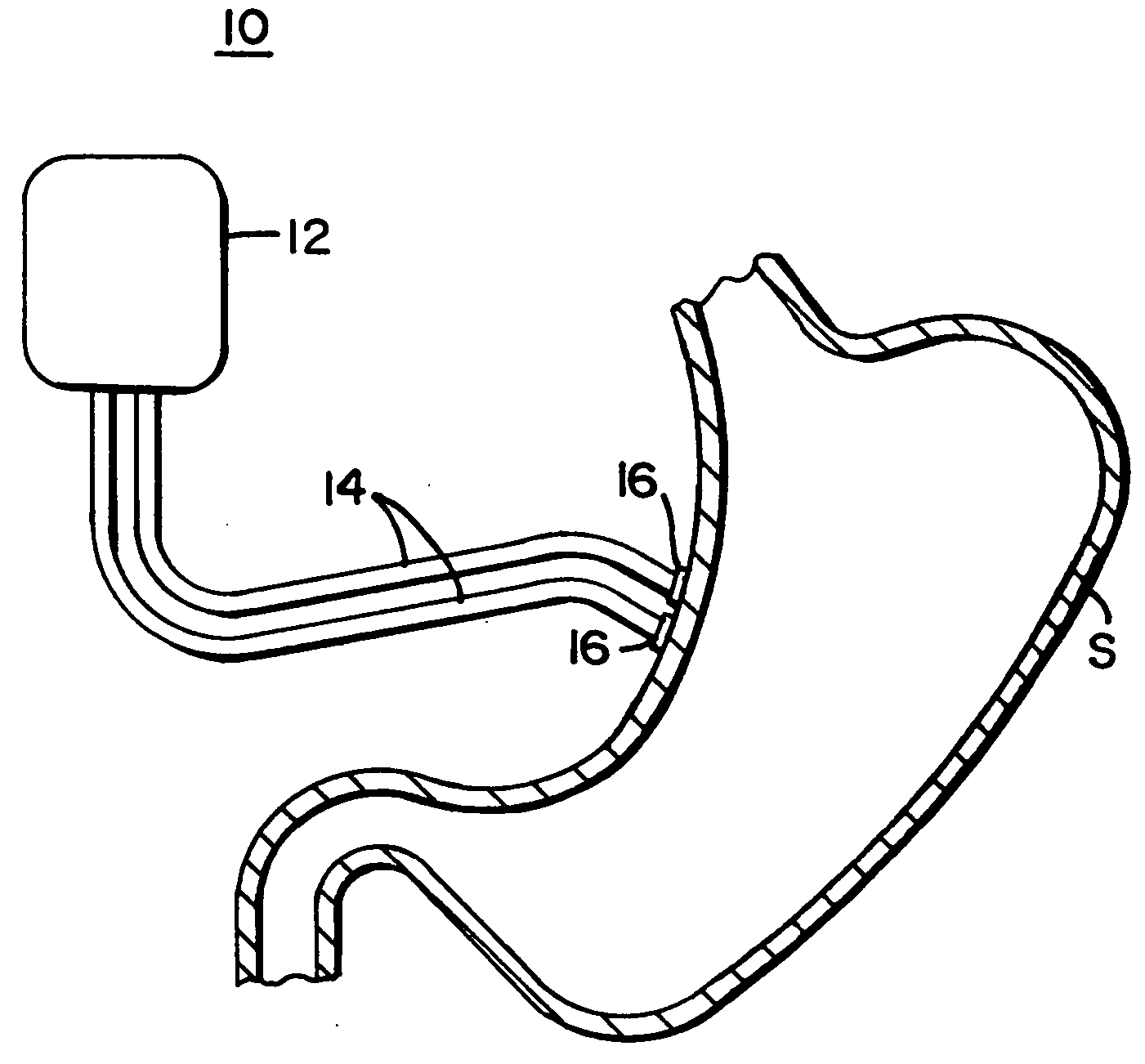 Gastric stimulator apparatus and method for use