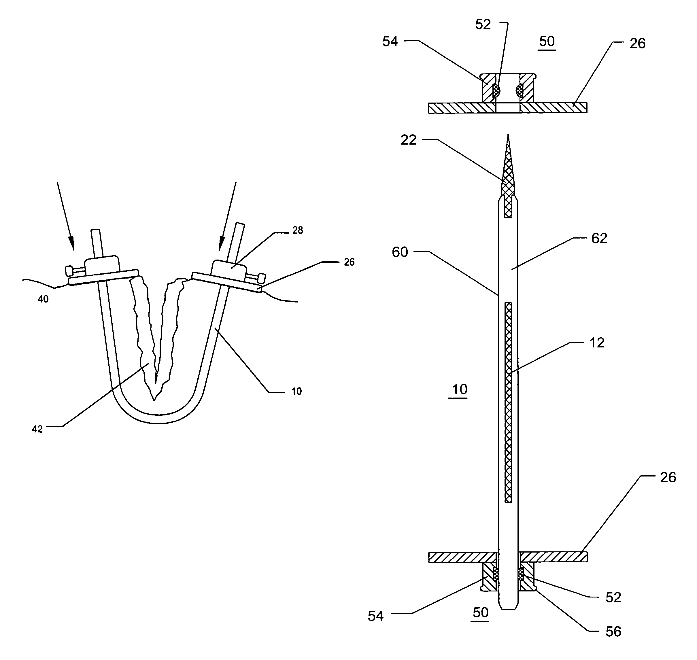 Method and apparatus for solid organ tissue approximation
