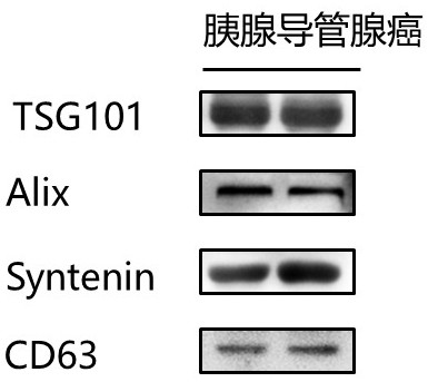 Detection reagent for biomarker used for authenticating and judging metastatic and non-metastatic pancreatic cancer, and application