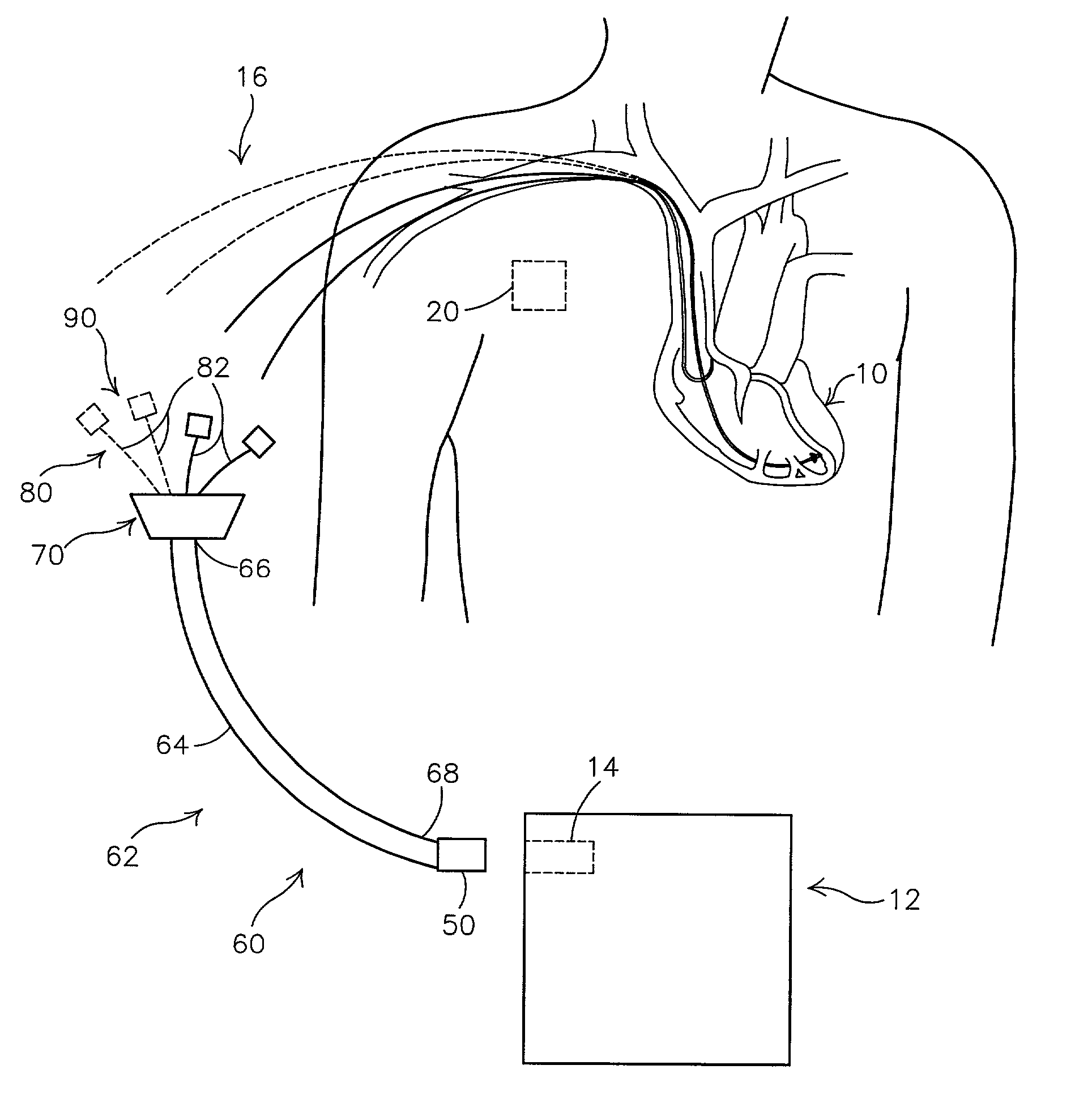 Bi-atrial and/or bi-ventricular patient safety cable and methods regarding same