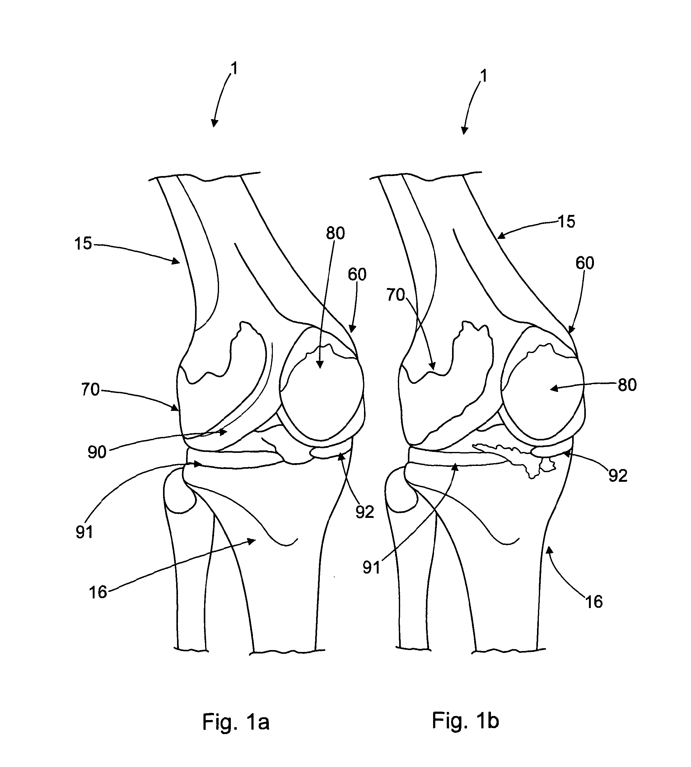 Tibial prosthetic component for a partial or unicondylar bearing knee replacement, method of selecting such a tibial prosthetic component, method of implanting such a tibial prosthetic component and a kit for a surgeon
