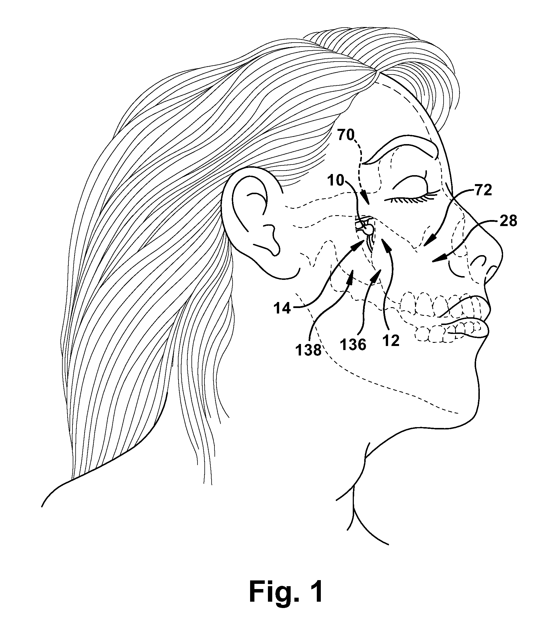Surgical tools to facilitate delivery of a neurostimulator into the pterygopalatine fossa