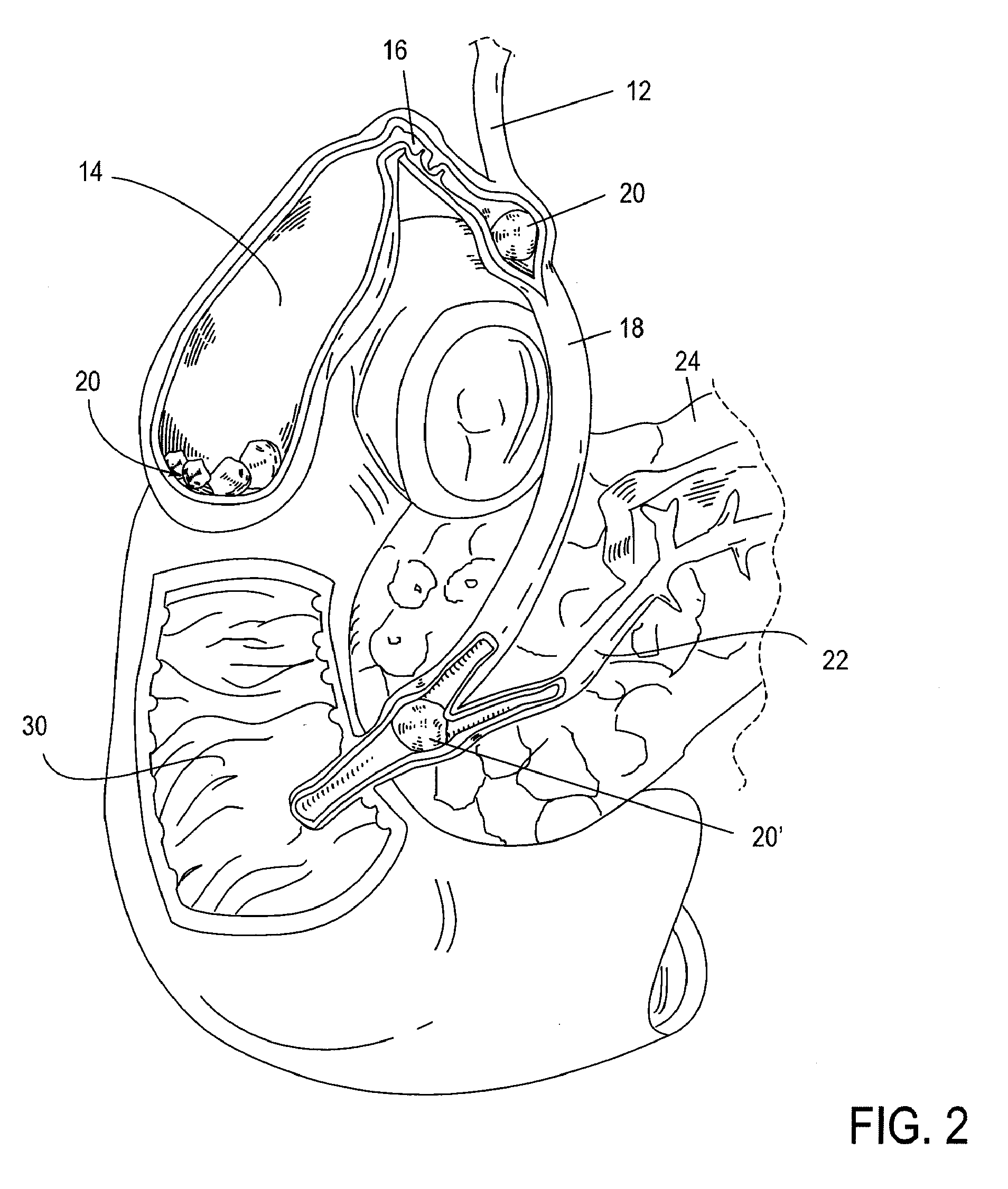 Biliary Shunts, Delivery Systems, Methods of Using the Same and Kits Therefor