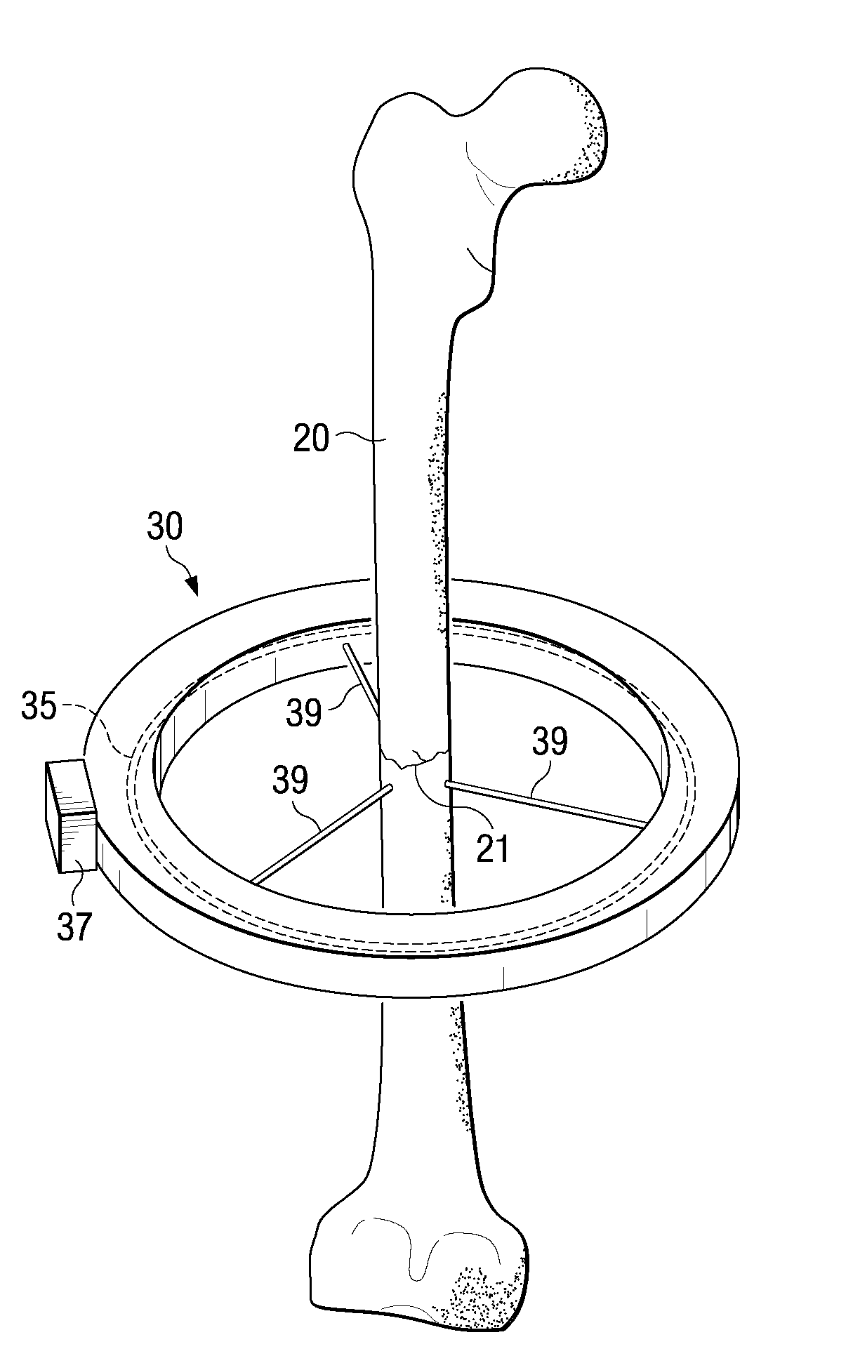 Encompassing external fixation device with incorporated pemf coil